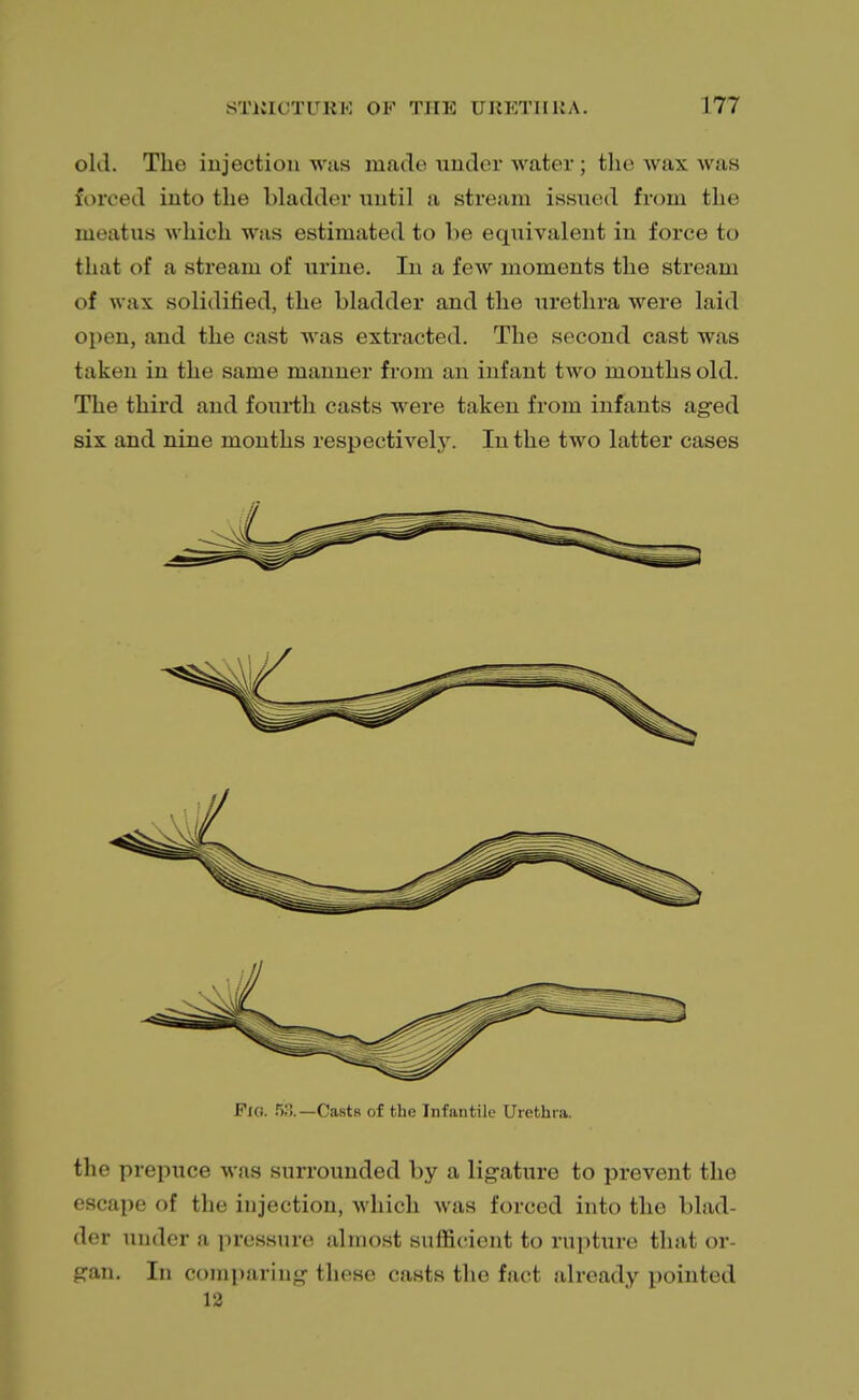 old. The injection was made under water; the wax was forced into the bladder until ji stream issued from the meatus which whs estimated to be equivalent in force to that of a stream of urine. In a few moments the stream of wax solidified, the bladder and the urethra were laid open, and the cast was extracted. The second cast was taken in the same manner from an infant two months old. The third and fourth casts were taken from infants aged six and nine months respectively. In the two latter cases Fig. 53.— Casts of the Infantile Urethra. the prepuce was surrounded by a ligature to prevent the escape of the injection, which was forced into the blad- der under a pressure almost sufficient to rupture that or- gan. In comparing these casts the fact already pointed 12
