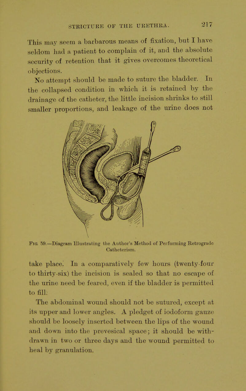 This may seem a barbarous means of fixation, but I have seldom had a patient to complain of it, and the absolute security of retention that it gives overcomes theoretical objections. No attempt should be made to suture the bladder. In the collapsed condition in which it is retained by the drainage of the catheter, the little incision shrinks to still smaller proportions, and leakage of the urine does not Fig. 59.—Diagram Illustrating the Author's Method of Performing Retrograde Catheterism. take place! In a comparatively few hours (twenty-four to thirty-six) the incision is sealed so that no escape of the urine need be feared, even if the bladder is permitted to fill. The abdominal wound should not be sutured, except at its upper and lower angles. A pledget of iodoform gauze should be loosely inserted between the lips of the wound and down into the prevesical space; it should be with- drawn in two or three days and the wound permitted to heal by granulation.