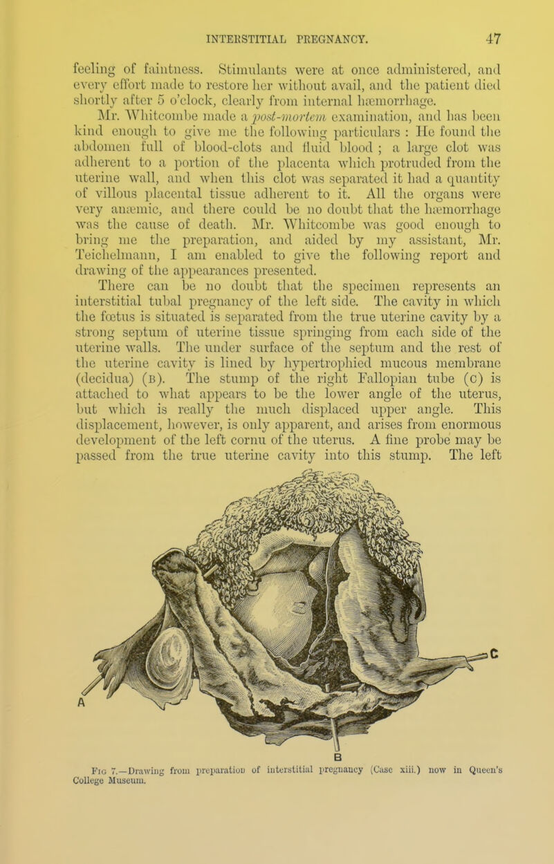 feeling of faiutncss. Stimulants were at once administered, and every effort made to restore her without avail, and the patient died shortly after 5 o'clock, clearly from internal lucmorrhage. Mr. AVhitconil)e made ^ imt-morteni examination, and has been kind enough to give me the following particulars : He found the abdomen full of blood-clots and fluid blood ; a large clot was adherent to a portion of the placenta which protruded from the uterine wall, and when this clot was separated it had a quantity of villous placental tissue adherent to it. All the organs were very anannic, and there could be no doubt that the hanuorrhage was the cause of death. INfr. AVhitcombe was good enough to bring me the preparation, and aided by my assistant, Mr. Teiclielmann, I am enabled to give tlie following report and drawing of the appearances presented. There can be no doubt that the specimen represents an interstitial tubal pregnancy of the left side. The cavity in which the foitus is situated is separated from the true uterine cavity by a strong septum of uterine tissue springing from each side of the uterine walls. The under surface of the septum and the rest of the uterine cavity is lined by hypertrophied mucous membrane (decidua) (b). The stump of the right Fallopian tube (c) is attached to what appears to be the lower angle of the uterus, but which is really the much displaced upper angle. This displacement, liowever, is only apparent, and arises from enormous development of the left cornu of the uterus. A fine probe may be passed from the true uterine cavity into this stump. The left B Fig 7.—Drawing from prcpaiatiuu of interstitial iircgnancy (Case xiii.) now iii Queen's College Museum.