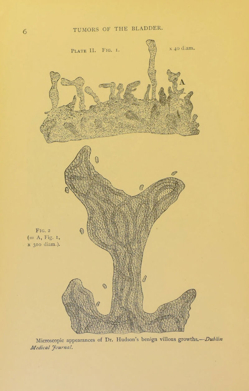 Microscopic appearances of Dr. Hudson's benign villous growths.—Dublin Medical Journal.