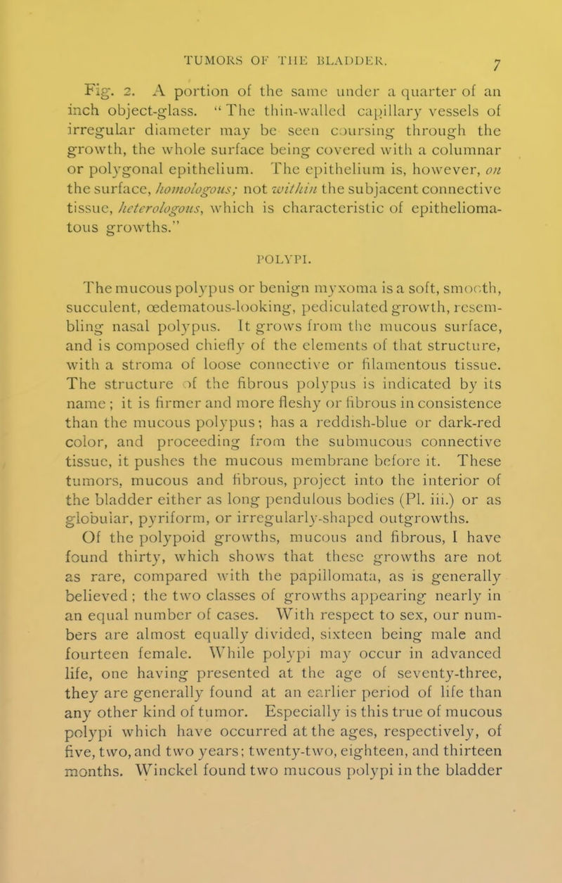Fig. 2. A portion of the same under a quarter of an inch object-glass.  The thin-walled capillary vessels of irregular diameter may be seen coursing through the growth, the whole surface being covered with a columnar or polygonal epithelium. The epithelium is, however, on the surface, homologous; not within the subjacent connective tissue, heterologous, which is characteristic of epithelioma- tous growths. POLYPI. The mucous polypus or benign myxoma is a soft, smooth, succulent, cedematous-looking, pediculated growth, resem- bling nasal polypus. It grows from the mucous surface, and is composed chiefly of the elements of that structure, with a stroma of loose connective or filamentous tissue. The structure of the fibrous polypus is indicated by its name ; it is firmer and more fleshy or fibrous in consistence than the mucous polypus; has a reddish-blue or dark-red color, and proceeding from the submucous connective tissue, it pushes the mucous membrane before it. These tumors, mucous and fibrous, project into the interior of the bladder either as long pendulous bodies (PI. iii.) or as globular, pyriform, or irregularly-shaped outgrowths. Of the polypoid growths, mucous and fibrous, I have found thirty, which shows that these growths are not as rare, compared with the papillomata, as is generally believed ; the two classes of growths appearing nearly in an equal number of cases. With respect to sex, our num- bers are almost equally divided, sixteen being male and fourteen female. While polypi may occur in advanced life, one having presented at the age of seventy-three, they are generally found at an earlier period of life than any other kind of tumor. Especially is this true of mucous polypi which have occurred at the ages, respectively, of five, two,and two years; twenty-two, eighteen, and thirteen months. Winckel found two mucous polypi in the bladder