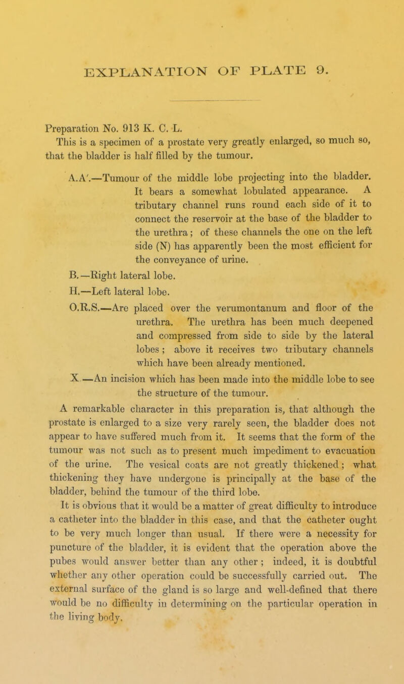 Preparation No. 913 K. C. L. This is a specimen of a prostate very greatly enlarged, so much so, that the bladder is half filled by the tumour. A. A'.—Tumour of the middle lobe projecting into the bladder. It bears a somewhat lobulated appearance. A tributary channel runs round each side of it to connect the reservoir at the base of the bladder to the urethra; of these channels the one on the left side (N) has apparently been the most efficient for the conveyance of urine. B. —Right lateral lobe. H,—Left lateral lobe. O.R.S.—Are placed over the verumontanum and floor of the urethra. The urethra has been much deepened and compressed from side to side by the lateral lobes; above it receives two tributary channels which have been already mentioned. X—An incision which has been made into the middle lobe to see the structure of the tumour. A remarkable character in this preparation is, that although the prostate is enlarged to a size very rarely seen, the bladder does not appear to have suffered much from it. It seems that the form of the tumour was not such as to present much impediment to evacuatiou of the urine. The vesical coats are not greatly thickened ; what thickening they have undergone is principally at the base of the bladder, behind the tumour of the third lobe. It is obvious that it would be a matter of great difficulty to introduce a catheter into the bladder in this case, and that the catheter ought to be very much longer than usual. If there were a necessity for puncture of the bladder, it is evident that the operation above the pubes would answer better than any other ; indeed, it is doubtful whether any other operation could be successfully carried out. The external surface of the gland is so large and well-defined that there would be no difficulty in determining on the particular operation in the living body.