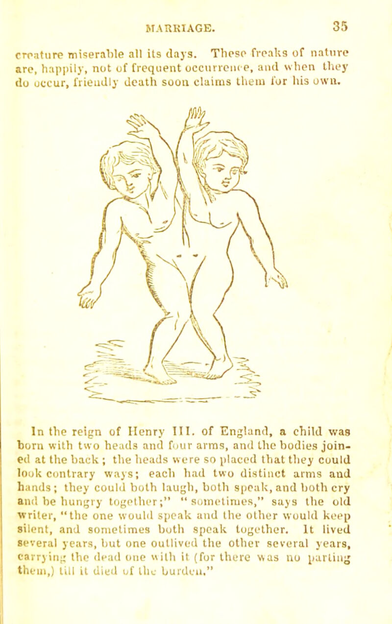 crnatiire miserable all ils days. Tlipso freaks of nature are, happily, not of frequent oecnrreoi e, and when Ihey du occur, frieudly death soon claims Iheiu for his own. In the reign of Henry III. of England, a child was born with two heads and four arras, and the bodies join- ed at the back ; the heads were so placed that they could look Contrary ways; each had two distinct arms aud hands; they could both laugh, both S|)Oak,and both cry and be hungry tcjgrlher;  snmctirues, says the old writer, the one woulil speak aud the other would keep silent, and sometimes both speak together. It lived several years, but one outlived the other several years, carrying Ihe dead one ilh it (for there was no jiartiui; them,) till it died of the burden,