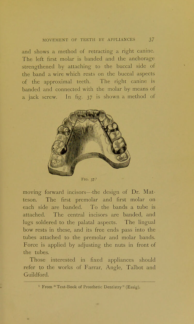 and shows a method of retracting a right canine. The left first molar is banded and the anchorage strengthened by attaching to the buccal side of the band a wire which rests on the buccal aspects of the approximal teeth. The right canine is banded and connected with the molar by means of a jack screw. In fig. 37 is shown a method of Fig. 37.' moving forward incisors—the design of Dr. Mat- teson. The first premolar and first molar on each side are banded. To the bands a tube is attached. The central incisors are banded, and lugs soldered to the palatal aspects. The lingual bow rests in these, and its free ends pass into the tubes attached to the premolar and molar bands. Force is applied by adjusting the nuts in front of the tubes. Those interested in fixed appliances should refer to the works of Farrar, Angle, Talbot and Guildford.