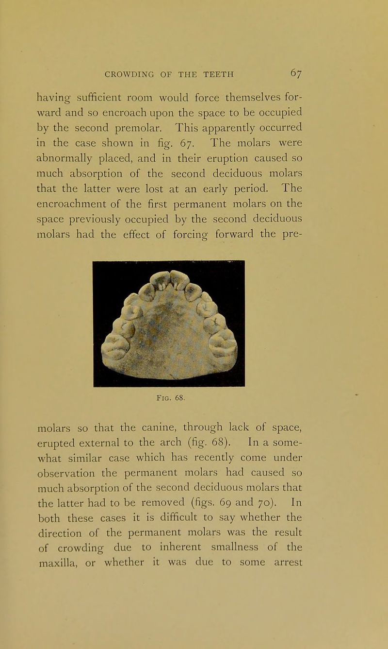 having- sufficient room would force themselves for- ward and so encroach upon the space to be occupied by the second premolar. This apparently occurred in the case shown in fig. 67. The molars were abnormally placed, and in their eruption caused so much absorption of the second deciduous molars that the latter were lost at an early period. The encroachment of the first permanent molars on the space previously occupied by the second deciduous molars had the effect of forcing forward the pre- FiG. 68. molars so that the canine, through lack of space, erupted external to the arch (fig. 68). In a some- what similar case which has recently come under observation the permanent molars had caused so much absorption of the second deciduous molars that the latter had to be removed (figs. 69 and 70). In both these cases it is difficult to say whether the direction of the permanent molars was the result of crowding due to inherent smallness of the maxilla, or whether it was due to some arrest