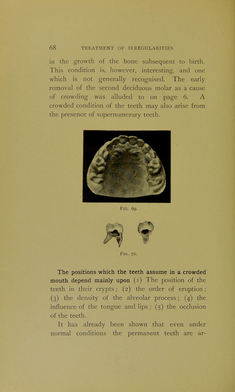 in the growth of the bone subsequent to birth. This condition is, however, interesting, and one which is not generally recognised. The early- removal of the second deciduous molar as a cause of crowding was alluded to on page 6. A crowded condition of the teeth may also arise from the presence of supernumerary teeth. Fig. 69. Fig. 70. The positions which the teeth assume in a crowded mouth depend mainly upon (i) The position of the teeth in their crypts ; (2) the order of eruption ; (3) the density of the alveolar process; (4) the influence of the tongue and lips ; (5) the occlusion of the teeth. It has already been shown that even under normal conditions the permanent teeth are ar-
