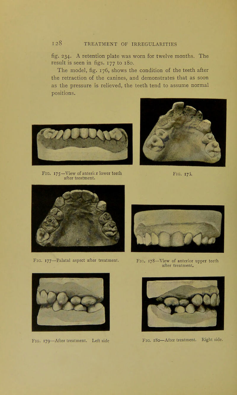 fig. 234. A retention plate was worn for twelve months. The result is seen in figs. 177 to 180. The model, fig. 176, shows the condition of the teeth after the retraction of the canines, and demonstrates that as soon as the pressure is relieved, the teeth tend to assume normal positions. Fig. 17s—View of antericr lower teeth Fig. 175. after treatment. Fig. 177—Palatal aspect after treatment. Fig. 178—View of anterior upper teeth after treatment. Fig. 179—After treatment. Leftside Fig. 180—After treatment. Right side.