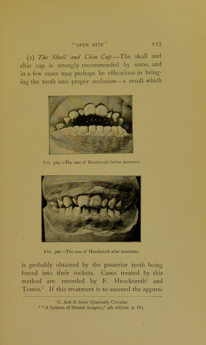 (2) The Skull and Chin Cap.—The skull and chin cap is strongly recommended by some, and in a few cases may perhaps be efficacious in bring- ing the teeth into proper occlusion—a result which Fig. 319.—The case of Heuckeroth before treatment. Fig. 320,—The case of Heuckeroth after treatment. is probably obtained by the posterior teeth being forced into their sockets. Cases treated by this method are recorded by F. Heuckeroth^ and Tomes.^ If this treatment is to succeed the appara- ' C. Ash & Sons' Quarterly Circular. '  A System of Dental Surgery, 4th edition p. 161.