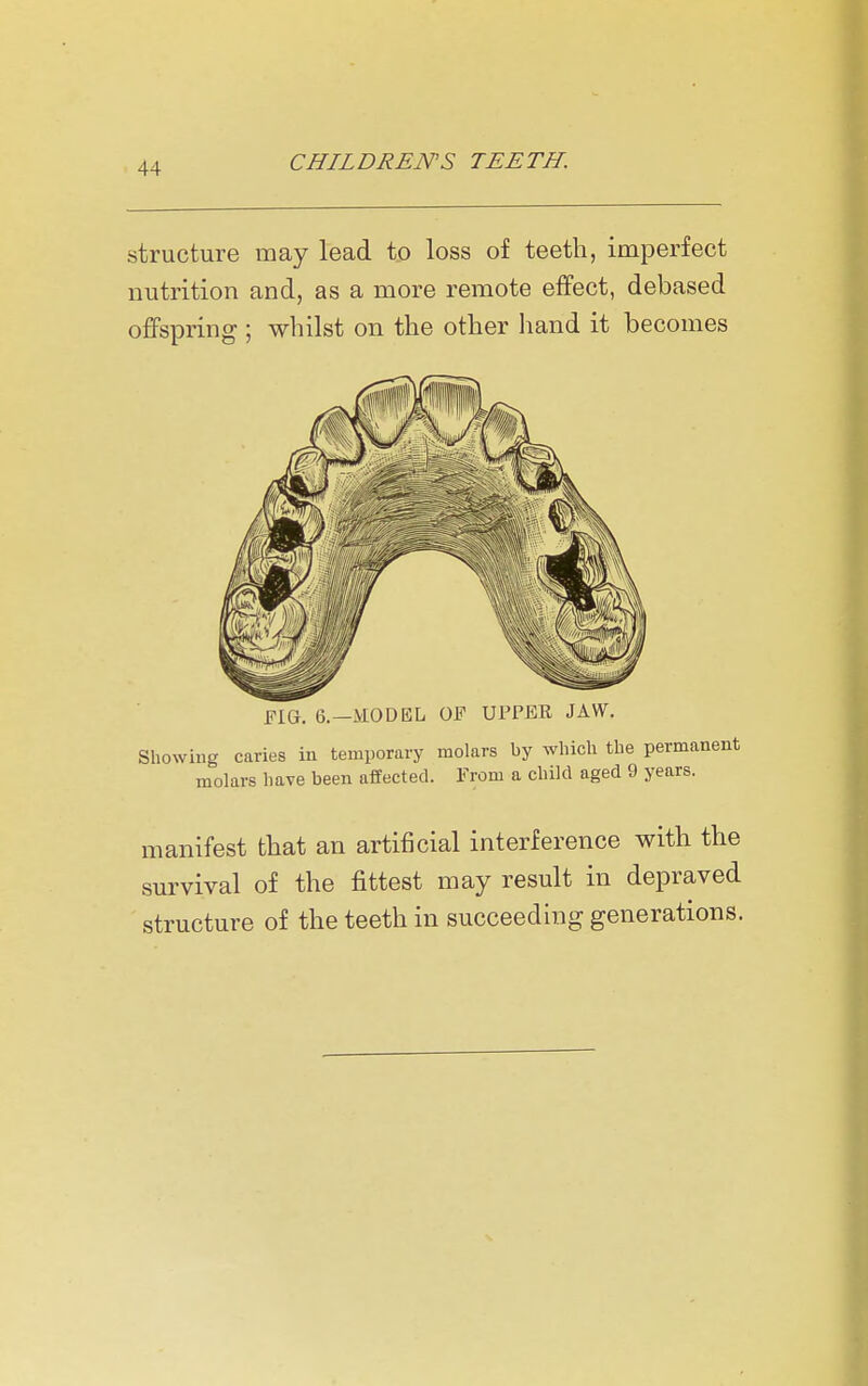 structure may lead to loss of teeth, imperfect nutrition and, as a more remote effect, debased offspring ; whilst on the other liand it becomes FIG, 6.—MODEL OF UPPER JAW. Showing caries in temporary molars by wliicli the permanent molars have been affected. From a child aged 9 years. m anifest that an artificial interference with the survival of the fittest may result in depraved structure of the teeth in succeeding generations.