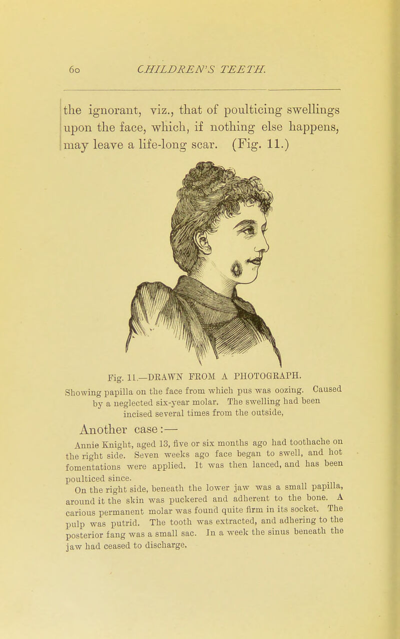 the ignorant, viz., that of poulticing swellings upon the face, which, if nothing else happens, may leave a life-long scar. (Fig. 11.) Fig. 11.—DRAWN FEOM A PHOTOGRAPH. Showing papilla on the face from which pus was oozing. Caused by a neglected six-year molar. The swelling had been incised several times from the outside, Another case:— Annie Knight, aged 13, five or six months ago had toothache on the right side. Seven weeks ago face began to swell, and hot fomentations were applied. It was then lanced, and has been poulticed since. On the right side, beneath the lower jaw was a small papilla, around it the sldn was puckered and adherent to the bone. A carious permanent molar was found quite Arm in its socket. The pulp was putrid. The tooth was extracted, and adhering to the posterior fang was a small sac. In a week the sinus beneath the jaw had ceased to discharge.