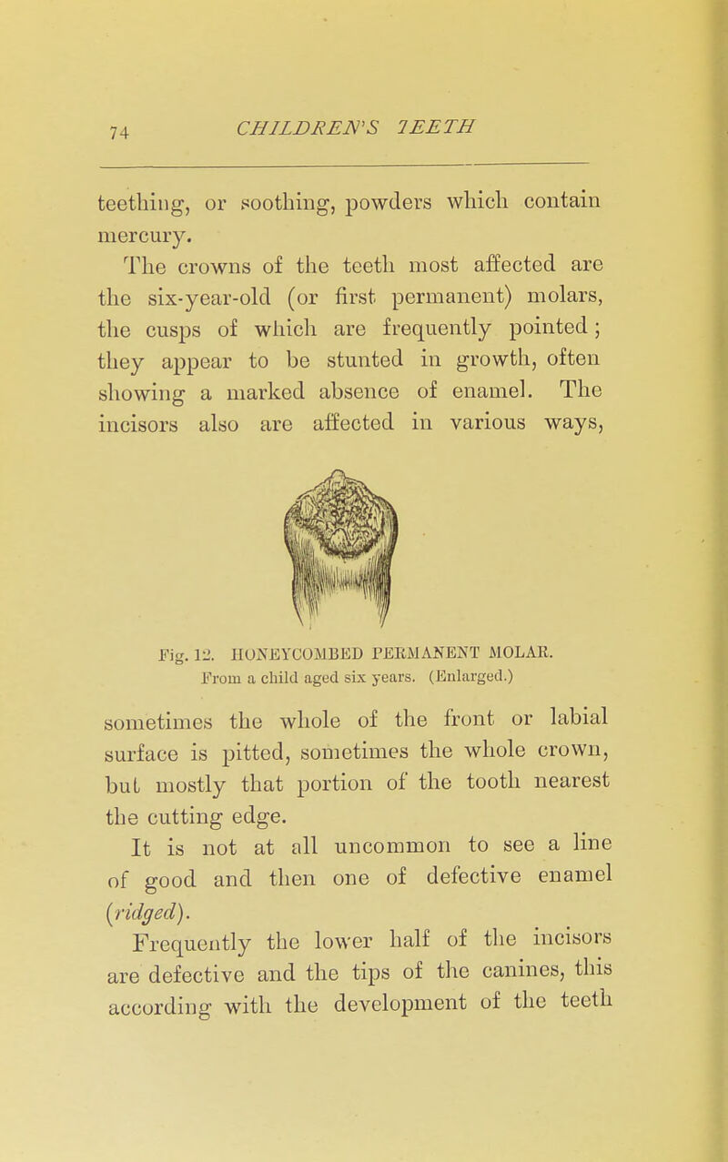 teething, or soothing, powders which contain mercury. The crowns of the teeth most affected are the six-year-old (or first permanent) molars, the cusps of which are frequently pointed; they appear to be stunted in growth, often showing a marked absence of enamel. The incisors also are affected in various ways, Fig. 12. HONEYCOMBED TERMANENT MOLAR. From a child aged six years. (Enlarged.) sometimes the whole of the front or labial surface is pitted, sometimes the whole crown, but mostly that portion of the tooth nearest the cutting edge. It is not at all uncommon to see a line of good and then one of defective enamel {I'idged). Frequently the lower half of tlie incisors are defective and the tips of the canines, this according with the development of the teeth