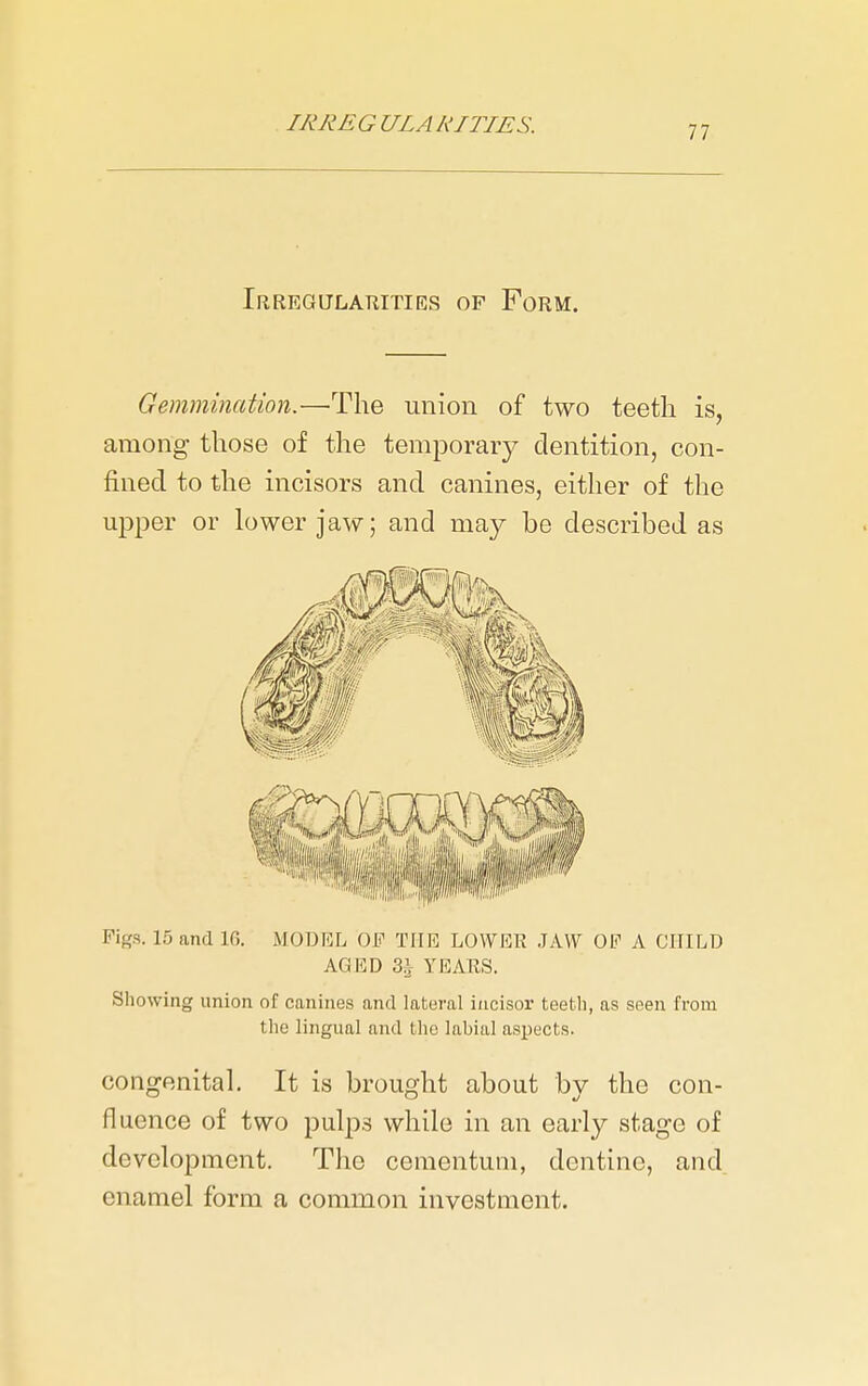 Irregularities of Form. Gemmination.—The union of two teeth is, among those of the temporary dentition, con- fined to the incisors and canines, either of the upper or lower jaw; and may be described as Figs. 15 and 16. MODEL OF TIIID LOWER JAW OF A CHILD AGED 3i YEAES. Showing union of canines and lateral incisor teeth, as seen from the lingual and the labial aspects. congenitaL It is brought about by the con- fluence of two pulps while in an early stage of development. The cementum, dentine, and. enamel form a common investment.