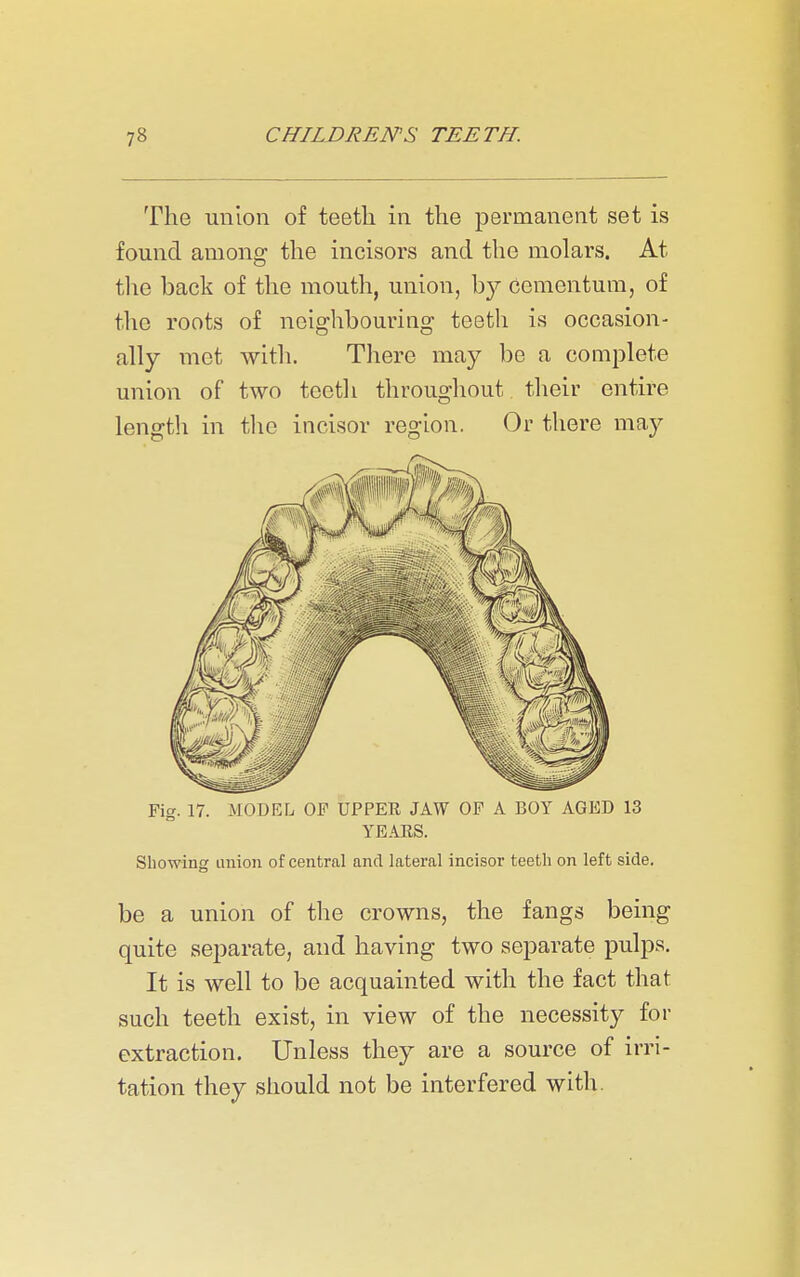 The union of teeth in the permanent set is found among the incisors and the molars. At the back of the mouth, union, by cementum, of the roots of neighbouring teeth is occasion- ally mot with. There may be a complete union of two teeth throughout their entire length in the incisor region. Or there may Fig. 17. MODEL OF UPPER JAW OF A BOY AGED 13 YEAES. Showing anion of central and lateral incisor teeth on left side. be a union of the crowns, the fangs being quite separate, and having two separate pulps. It is well to be acquainted with the fact that such teeth exist, in view of the necessity for extraction. Unless they are a source of irri- tation they should not be interfered with.