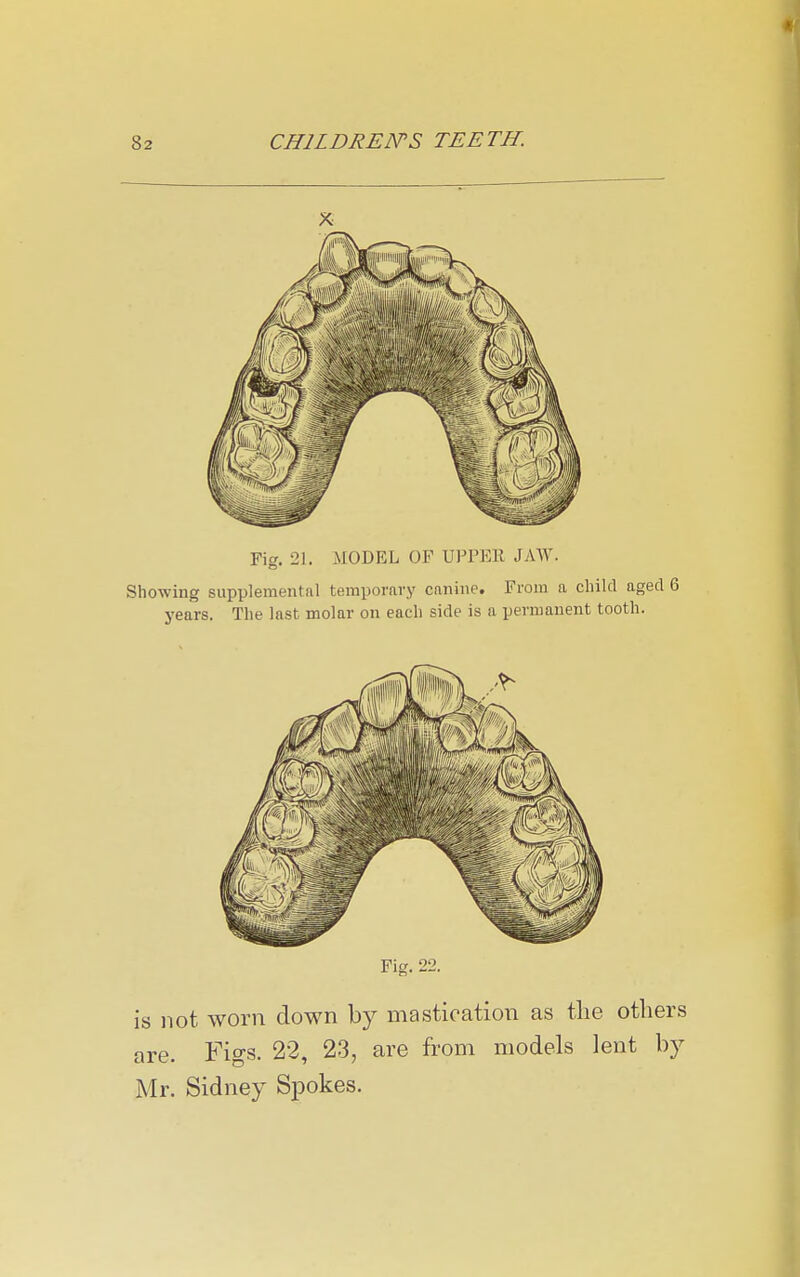 Fig. 21. MODEL OF UPPEll JAW. Showing supplemental temporary canine. From a child aged 6 years. The last molar on each side is a permanent tooth. Fig. 22. is not worn down by mastication as tlie others are. Figs. 22, 23, are from models lent by Mr. Sidney Spokes.