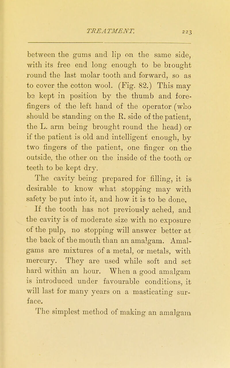 between the gums and lip on tlie same side, with its free end long enough to be brought round the last molar tooth and forward, so as to cover the cotton wool. (Fig. 82.) This may ba kept in position by the thumb and fore- fingers of the left hand of the operator (who should be standing on the R. side of the patient, the L. arm being brought round the head) or if the patient is old and intelligent enough, by two fingers of the patient, one finger on the outside, the other on the inside of the tooth or teeth to be kept dry. The cavity being prepared for filling, it is desirable to know what stopping may with safety be put into it, and how it is to be done. If the tooth has not previously ached, and the cavity is of moderate size with no exposure of the pulp, no stopping will answer better at the back of the mouth than an amalgam. Amal- gams are mixtures of a metal, or metals, with mercury. They are used while soft and set hard within an hour. When a good amalgam is introduced under favourable conditions, it will last for many years on a masticating sur- face. The simplest method of making an amalgam