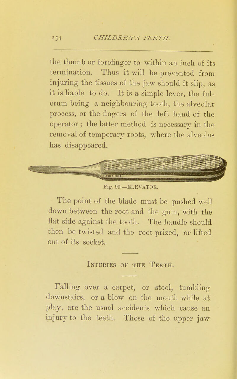 the thumb or forefiager to within an inch of its termination. Thus it will be prevented from injuring the tissues of the jaw should it slip, as it is liable to do. It is a simple lever, the ful- crum being a neighbouring tooth, the alveolar process, or the fingers of the left hand of the operator ; the latter method is necessary in the removal of temporary roots, whore the alveolus has disappeared. Fig. 09.—ELEVATOE. The point of the blade must be pushed well down between the root and the gum, with the flat side against the tooth. The handle should then be twisted and the root prized, or lifted out of its socket. Injuries of the Teeth. Falling over a carpet, or stool, tumbling downstairs, or a blow on the mouth while at play, are the usual accidents which cause an injury to the teeth. Those of the upper jaw