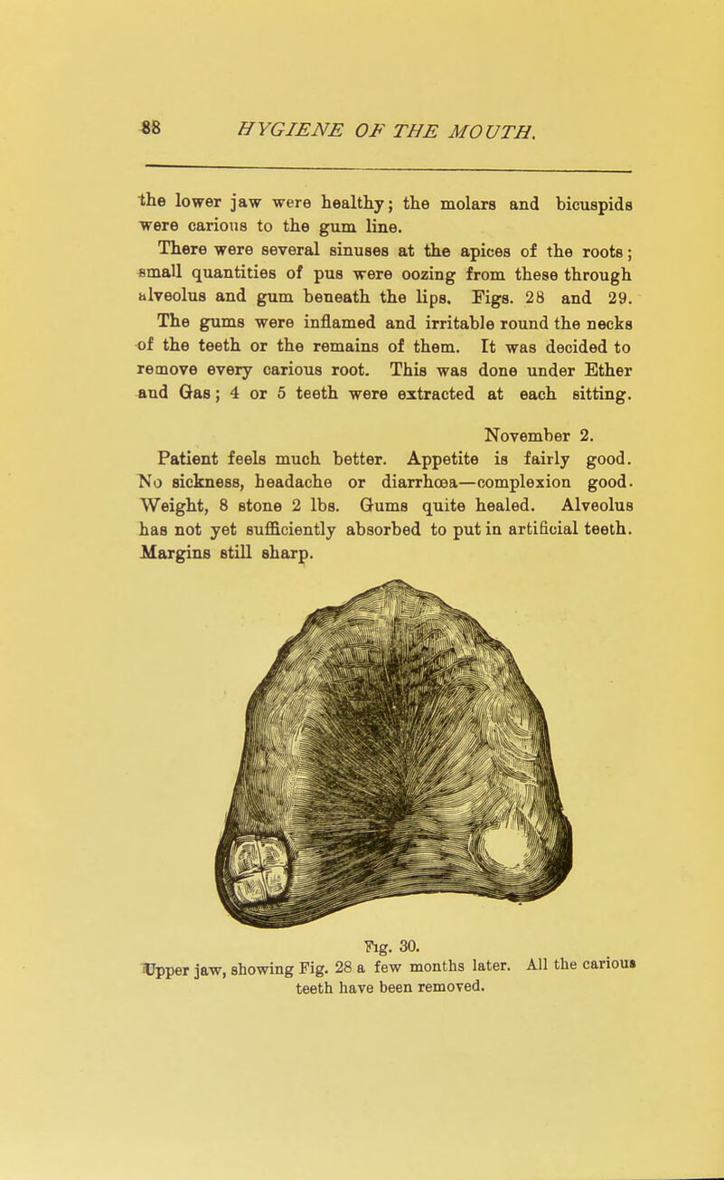 the lower jaw were healthy; the molars and bicuspids were carious to the gum line. There were several sinuses at the apices of the roots; small quantities of pus were oozing from these through alveolus and gum beneath the lips. Figs. 28 and 29. The gums were inflamed and irritable round the necks of the teeth or the remains of them. It was decided to remove every carious root. This was done under Ether and Gas; 4 or 5 teeth were extracted at each sitting. November 2. Patient feels much better. Appetite is fairly good. No sickness, headache or diarrhoea—complexion good. Weight, 8 stone 2 lbs. Gums quite healed. Alveolus has not yet sufficiently absorbed to put in artificial teeth. Margins still sharp. Fig. 30. 'Upper jaw, showing Fig. 28 a few months later. All the carious teeth have been removed.