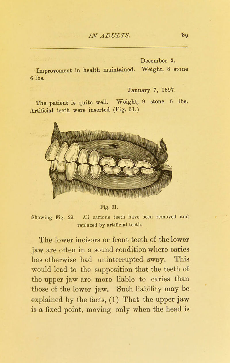 December 3. Improvement in health maintained. Weight, 8 stone 6 lbs. January 7, 1897. The patient is quite well. Weight, 9 stone 6 lbs. Artificial teeth were inserted (Fig. 31.) Fig. 31. Showing Fig. 29. All carious teeth have been removed and replaced by artificial teeth. The lower incisors or front teeth of the lower jaw are often in a sound condition where caries has otherwise had uninterrupted sway. This would lead to the supposition that the teeth of the upper jaw are more liable to caries than those of the lower jaw. Such liability may be explained by the facts, (1) That the upper jaw is a fixed point, moving only when the head is