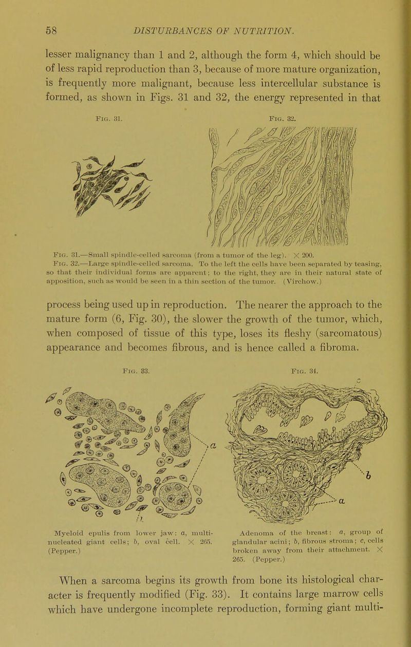 lesser malignancy than 1 and 2, although the form 4, which should be of less rapid reproduction than 3, because of more mature organization, is frequently more malignant, because less intercellular substance is formed, as shown in Figs. 31 and 32, the energy represented in that Fig. 31. Fig. 32. Fio. 31.—Siniill spiiidlf-wllod .'wircomii (from ii tumor of the leg). X 200. Fig. 32.—Liu-Ke .spindle-eelled siircoina. To tlie left the cell.s have been separated by teasing, so that their iiidivlchnil forin.s are apparent; to the right, they are in their natural .state of apposition, sueli a.s would be .seen in a tliin section of the tumor. (Virehow.) process being used up in reproduction. The nearer the approach to the mature form (6, Fig. 30), the slower the growth of the tumor, which, when composed of tissue of this type, loses its fleshy (sarcomatous) appearance and becomes fibrous, and is hence called a fibroma. Fio. 33. Fig. 31. Jlyeloid epulis from lower jaw: a, multi- Adenoma of the breast: o, group of nucleated giant cells; &, oval cell. X 265. glandular acini; 6, fibrous stroma; c, cells (Pepper.) broken away from their attachment. X 265. (Pepper.) When a sarcoma begins its growth from bone its histological char- acter is frequently modified (Fig. 33). It contains large marrow cells which have undergone incomplete reproduction, forming giant multi-