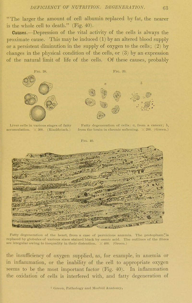 The larger the amount of cell albumin replaced by fat, the nearer is the whole cell to death. (Fig. 40). Causes.—Depression of the vital activity of the cells is always the proximate cause. This may be induced (1) by an altered blood supply or a persistent diminution in the supply of oxygen to the cells; (2) by changes in the physical condition of the cells, or (3) by an expression of the natural limit of life of the cells. Of these causes, probably 6 a, I'rom a cancer; 6, hiff. X 200. (Green.) Fig. 40. Fatty ile^rcncration of the licart, fi-oin a case of pernicious anicniia. The protoiiJasniyis replaced by {rlohules of various sizes st.ained black by osmic acid. The outlines of the fibres are irregular owinK to inef|uality in their distention. X JOO. (Green.) the insufficiency of oxygen supplied, as, for example, in antemia or in inflammation, or the inability of the cell to appropriate oxygen seems to be the most important factor (Fig. 40). In inflammation the oxidation of cells is interfered with, and fatty degeneration of ' flrccn, P;illioli)f;y and Morbid Anatomy.