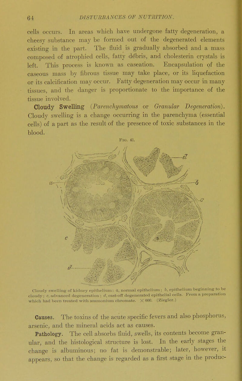 cells occurs. In areas which have undergone fatty degeneration, a cheesy substance may be formed out of the degenerated elements existing in the part. The fluid is gradually absorbed and a mass composed of atrophied cells, fatty debris, and cholesterin crystals is left. This process is known as caseation. Encapsulation of the caseous mass by fibrous tissue may take place, or its liquefaction or its calcification may occur. Fatty degeneration may occur in many tissues, and the danger is proportionate to the importance of the tissue involved. Cloudy Swelling {Parenchymatom or Granular Degeneration). Cloudy swelling is a change occurring in the parenchyma (essential cells) of a part as the result of the presence of toxic substances in the blood. Fig. 41. ■ 1/.^^ II Cloudy swelling of kidney epitlielium : a, normal epithelium; b, epithelium beginniiiK to be cloudy ; c, advanced deseneration ; cl, cast-olT degenerated epithelial cells. Fi-oni a jireparation which had been treated with ammonium chromate. X 600. (Ziegler.) Causes. The toxins of the acute specific fevers and also phosphorus, arsenic, and the mineral acids act as causes. Pathology. The cell absorbs fluid, swells, its contents become gran- ular, and the histological structure is lost. In the eariy stages the change is albuminous; no fat is demonstrable; later, however, it appears, so that the change is regarded as a first stage in the produc-