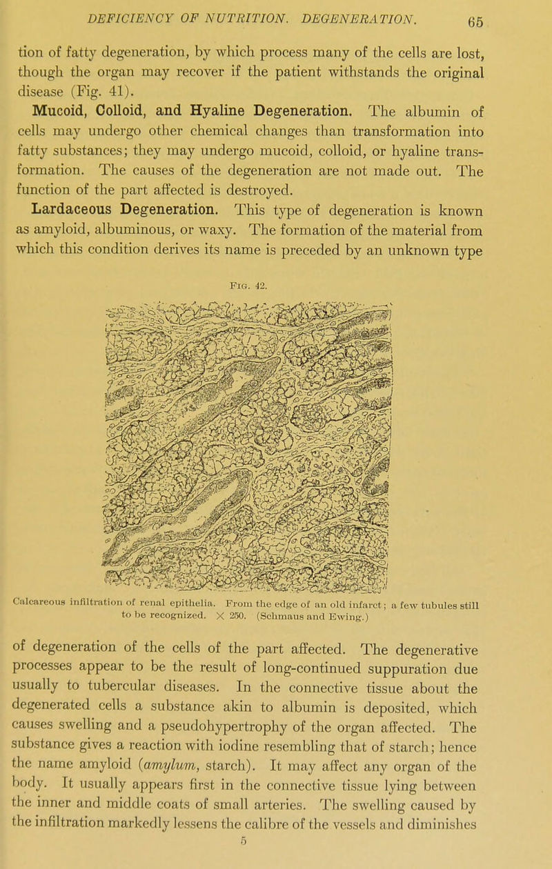 tion of fatty degeneration, by which process many of the cells are lost, though the organ may recover if the patient withstands the original disease (Fig. 41). Mucoid, Colloid, and Hyaline Degeneration. The albumin of cells may undergo other chemical changes than transformation into fatty substances; they may undergo mucoid, colloid, or hyaline trans- formation. The causes of the degeneration are not made out. The function of the part affected is destroyed. Lardaceous Degeneration. This type of degeneration is known as amyloid, albuminous, or waxy. The formation of the material from which this condition derives its name is preceded by an unknown type Fig. i2. Calcareous infiltration of renal epithelia. From the edge of an old infarct; a few tubules still to be recognized. X 2.50. (Schmaus and Ewing.) of degeneration of the cells of the part affected. The degenerative processes appear to be the result of long-continued suppuration due usually to tubercular diseases. In the connective tissue about the degenerated cells a substance akin to albumin is deposited, which causes swelling and a pseudohypertrophy of the organ affected. The substance gives a reaction with iodine resembling that of starch; hence the name amyloid {amylum, starch). It may affect any organ of the body. It usually appears first in the connective tissue lying between the inner and middle coats of small arteries. The swelling caused by the infiltration markedly lessens the calibre of the vessels and diminishes 6