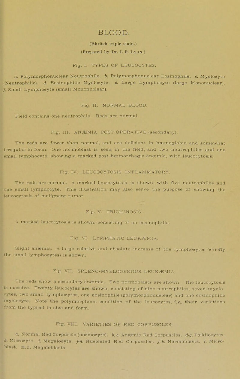 BLOOD. (Ehrlich triple stain.) (Prepared by Dr. I. P. Lyon.) Fig. I. TYPES OF LEUCOCYTES. a. Polymorphonuclear Neutrophils, ft. Polymorphonuclear Eosinophils, c. Myelocyte (Neutrophilic), d. Eosinophilic Myelocyte. «. Large Lymphocyte (large Mononuclear). /. Small Lymphocyte (small Mononuclear). Fig. II. NORMAL BLOOD. Field contains one neutrophils. Reds are normal. Fig. III. AN/EMIA. POST-OPERATIVE (secondary). The reds are fewer than normal, and are deficient in heemoglobin and somewhat irregular in form. One normoblast is seen in the field, and two neutrophiles and one small lymphocyte, showing a marked post-hsemorrhagio anaemia, with leucocytosis. Fig. IV. LEUCOCYTOSIS, INFLAMMATORY. The reds are normal. .A marked leucocytosis is shown, with five neutrophiles and one small lymphocyte. This illustration may also serve the purpose of showing the leucocytosis of malignant tumor. Fig. V. TRICHINOSIS. .■\ marked leucocytosis is shown, consisting of an eosinophilia. Fig. VI. LYMPHATIC LEUK/EMIA. Slight aneemia. .A large relative and absolute increase of the lymphocytes 'chiefly the small lymphocytes) is shown. Fig. VII. SPLENO-MYELOGENOUS LEUKEMIA. The reds show a secondary anremia. Two normoblasts are shown. Tho leucocytosis i~ massive. Twenty leucocytes are shown, consisting of nine neutrophiles, seven myelo- i-ytes, two small lymphocytes, one eosinophile (polymorphonuclear) and one eosinophilic myelocyte. Note the polymorphous condition of the leucocytes, i.e., their variations from the typical in sxT.e and form. Fig. VIII. VARIETIES OF RED CORPUSCLES. a. Normal Red Corpuscle (normocyte). 6, c. Aneemic Red Corpuscles, d-^. Poikilocytes. h. Microcyte. i. Megalocyte. j-n. Nucleated Red Corpuscles, j.k. Normoblasts. I. Mi(!ro- blast. m.n. Megaloblasts.