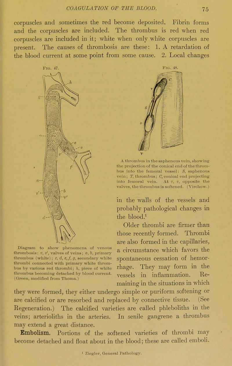 corpuscles and sometimes the red become deposited. Fibrin forms and the corpuscles are included. The thrombus is red when red corpuscles are included in it; white when only white corpuscles are present. The causes of thrombosis are these: 1. A retardation of the blood current at some point from some cause. 2. Local changes A thrombus in tlie saphenous \'ein, showing the projection of the conical end of the throm- bus into tlie femoral vessel: S, saphenous vein; T, thrombus; C, conical end projecting into femoral vein. At v, v, opposite the valves, the thrombus is softened. (Virchow.) in the walls of the vessels and probably pathological changes in the blood.^ Older thrombi are firmer than those recently formed. Thrombi are also formed in the capillaries, Diagram to show phenomena of venous cirCUmstaUCe which faVOrS the thrombosis: v, v, valves of veins; a, o, primary thrombus (white); c, rf, e,/, ,(7, secondary white spOUtaUCOUS CCSSation of llCmOr- thrombi connected with primary white throm- . » . , bus by various red thrombi; h, piece of white rhage. i hcy may torm m the thrombus becoming detached by blood current. yeSScls in inflammation. Rc- (Green, modified from Thoma.) maining in the situations in which they were formed, they either undergo simple or puriform softening or are calcified or are resorbed and replaced by connective tissue. (See Regeneration.) The calcified varieties are called phleboliths in the veins; arterioliths in the arteries. In senile gangrene a thrombus may extend a great distance. Embolism. Portions of the softened varieties of thrombi may become detached and float about in the blood; these are called emboli.