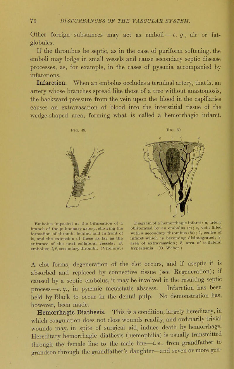 Other foreign substances may act as emboli — e. cj., air or fat- globules. If the thrombus be septic, as in the case of puriform softening, the emboli may lodge in small vessels and cause secondary septic disease processes, as, for example, in the cases of pyaemia accompanied by infarctions. Infarction. When an embolus occludes a terminal artery, that is, an artery whose branches spread like those of a tree without anastomosis, the backward pressure from the vein upon the blood in the capillaries causes an extravasation of blood into the interstitial tissue of the wedge-shaped area, forming what is called a hemorrhagic infarct. Fu;. W. Fig. 50. a V Embolus impacted at the bifurcation of a Diagram of a hemorrhagic infarct: a, artery branch of the pulmonary artery, showing the obliterated by an embolus (c); v, vein filled formation of thrombi behind and in front of with a secondary thrombus ((/i); 1, centre of it, and the extension of these as far as the infarct which is becoming disintegrated; 2, entrance of the next collateral vessels: E, area of extravasation; 3, area of collateral embolus; secondary thrombi. (Virehow.) hyperemia. (O.Weber.) A clot forms, degeneration of the clot occurs, and if aseptic it is absorbed and replaced by connective tissue (see Regeneration); if caused by a septic embolus, it may be involved in the resulting septic process—e.g., in pyeemic metastatic abscess. Infarction has been held by Black to occur in the dental pulp. No demonstration has, however, been made. Hemorrhagic Diathesis. This is a condition, largely hereditary, in which coagulation does not close wounds readily, and ordinarily trivial wounds may, in spite of surgical aid, induce death by hemorrhage. Hereditary hemorrhagic diathesis (haemophilia) is usually transmitted through the female line to the male line—i. e., from grandfather to grandson through the grandfather's daughter—and seven or more gen-