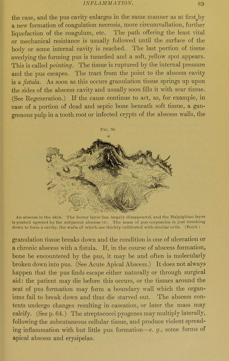 the case, and the pus cavity enlarges in the same manner as at first^by a new formation of coagulation necrosis, more circumvallation, further liquefaction of the coagulum, etc. The path offering the least vital or mechanical resistance is usually followed until the surface of the body or some internal cavity is reached. The last portion of tissue overlying the forming pus is tumefied and a soft, yellow spot appears. This is called pointing. The tissue is ruptured by the internal pressure and the pus escapes. The tract from the point to the abscess cavity is a fistula. As soon as this occurs granulation tissue springs up upon the sides of the abscess cavity and usually soon fills it with scar tissue. (See Regeneration.) If the cause continue to act, as, for example, in case of a portion of dead and septic bone beneath soft tissue, a gan- grenous pulp in a tooth root or infected crypts of the abscess walls, the Fig. 56. a An abscess in the skin. The horny layer has largely disappeared, and the Malpighian layer is pu.shed upward by the subjacent abscess (a). The mass of pus corpuscles is just breaking down to form a cavity, the walls of which are thickly infiltrated with similar cells. (Boyd.) granulation tissue breaks down and the condition is one of ulceration or a chronic abscess with a fistula. If, in the course of abscess formation, bone be encountered by the pus, it may be and often is molecularly broken down into pus. (See Acute Apical Abscess.) It does not always happen that the pus finds escape either naturally or through surgical aid: the patient may die before this occurs, or the tissues around the seat of pus formation may form a boundary wall which the organ- isms fail to break down and thus die starved out. The abscess con- tents undergo changes resulting in caseation, or later the mass may calcify. (See p. 64.) The streptococci pyogenes may multiply laterally, following the subcutaneous cellular tissue, and produce violent spread- ing inflammation with but little pus formation—e. g., some forms of apical abscess and erysipelas.