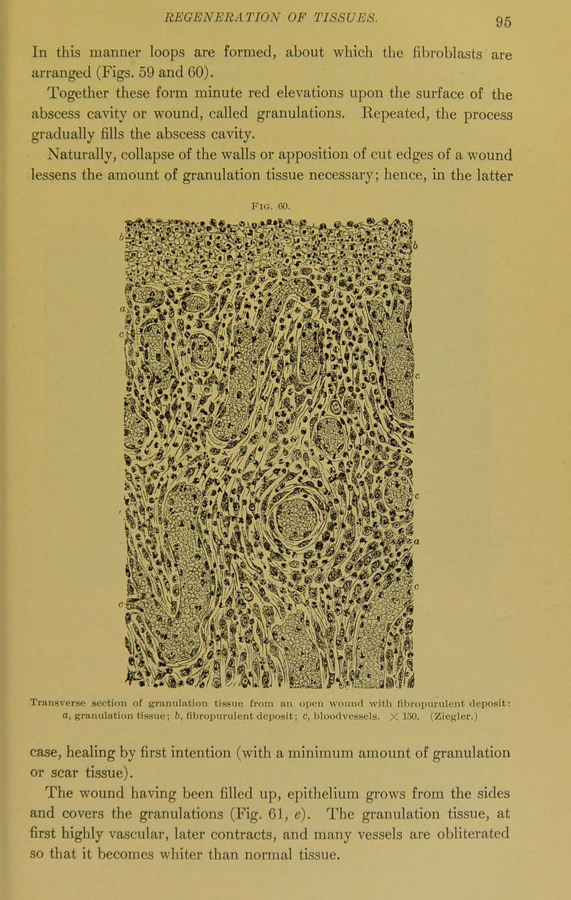 In this manner loops are formed, about which the fibroblasts are arranged (Figs. 59 and 60). Together these form minute red elevations upon the surface of the abscess cavity or wound, called granulations. Repeated, the process gradually fills the abscess cavity. Naturally, collapse of the walls or apposition of cut edges of a wound lessens the amount of granulation tissue necessary; hence, in the latter Fig. 60. Transveree section of granulation tis-suc from an open wound witli fibropurulent deposit: a, granulation tissue; 6, fibropurulent deposit; c, bloodvessels. X 150. (Ziegler.) case, healing by first intention (with a minimum amount of granulation or scar tissue). The wound having been filled up, epithelium grows from the sides and covers the granulations (Fig. 61, e). The granulation tissue, at first highly vascular, later contracts, and many vessels are obliterated so that it becomes whiter than normal tissue.