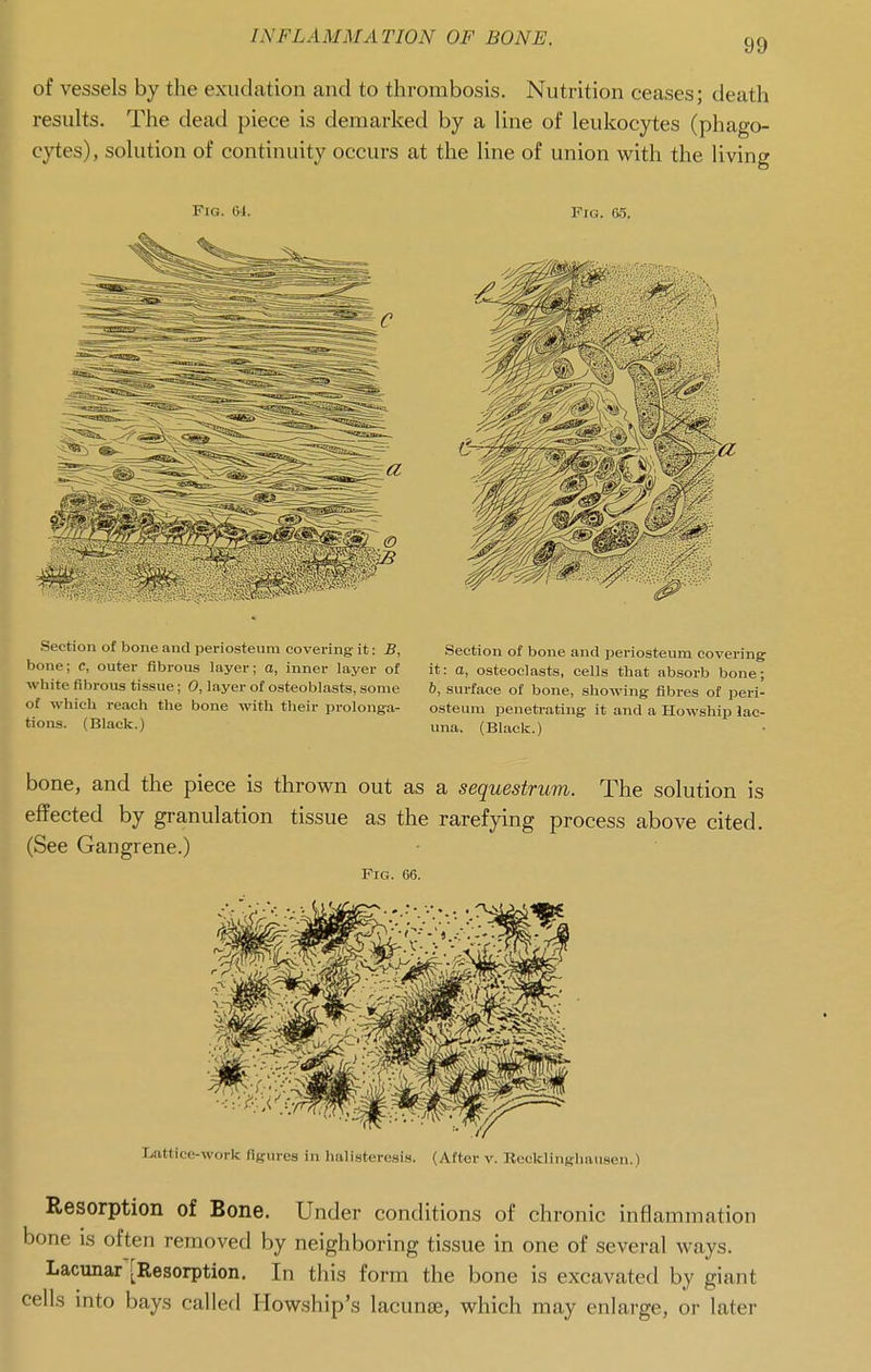 of vessels by the exudation and to thrombosis. Nutrition ceases; death results. The dead piece is demarked by a line of leukocytes (phago- cytes), solution of continuity occurs at the line of union with the living Fig. 6i. Fici. 65. Section of bone and periosteum covering it: B, bone; c, outer fibrous layer; a, inner layer of white fibrous tissue; 0, layer of osteoblasts, some of which reach the bone with their prolonga- tions. (Black.) Section of bone and ijeriosteum covering it: a, osteoclasts, cells that absorb bone; 6, surface of bone, showing fibres of peri- osteum penetrating it and a Howship lac- una. (Black.) bone, and the piece is thrown out as a sequestrum. The solution is effected by granulation tissue as the rarefying process above cited. (See Gangrene.) Fig. 66. Lattice-work figures in halisteresi.s. (After v. Recklinghausen.) Resorption of Bone. Under conditions of chronic inflammation bone IS often removed by neighboring tissue in one of several ways. Lacunar [Resorption. In this form the bone is excavated by giant cells into bays called Howship's lacunte, which may enlarge, or later