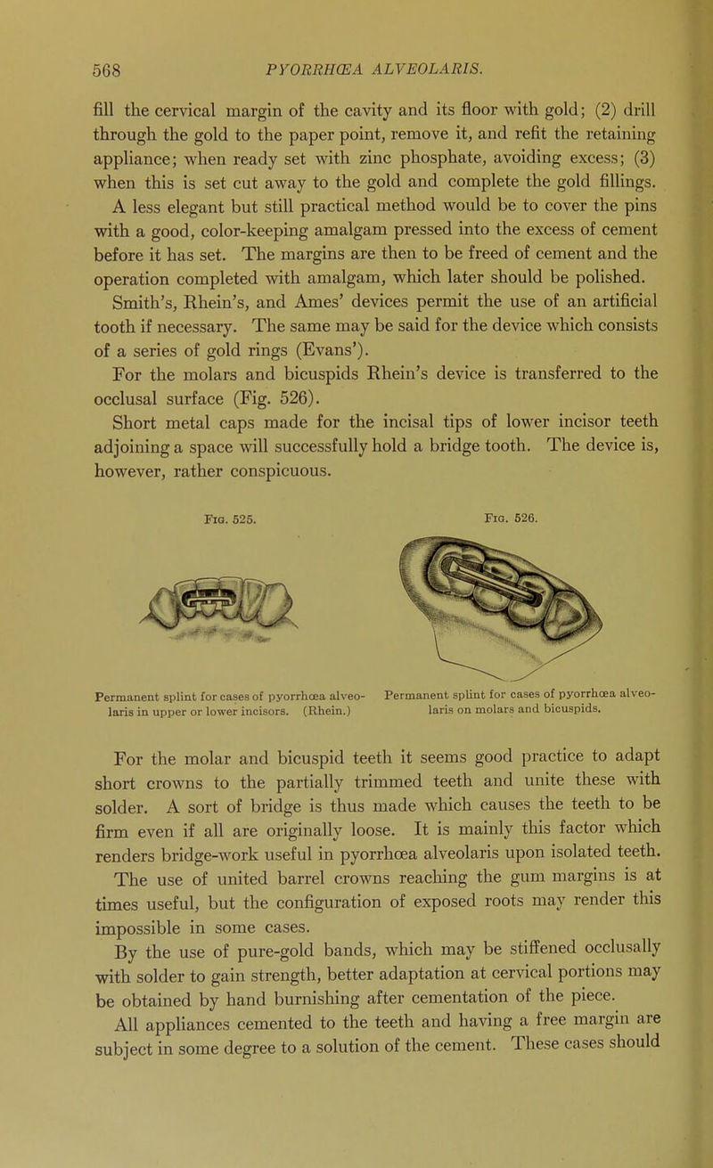 fill the cervical margin of the cavity and its floor with gold; (2) drill through the gold to the paper point, remove it, and refit the retaining apphance; when ready set with zinc phosphate, avoiding excess; (3) when this is set cut away to the gold and complete the gold fillings. A less elegant but still practical method would be to cover the pins with a good, color-keeping amalgam pressed into the excess of cement before it has set. The margins are then to be freed of cement and the operation completed with amalgam, which later should be polished. Smith's, Rhein's, and Ames' devices permit the use of an artificial tooth if necessary. The same may be said for the device which consists of a series of gold rings (Evans'). For the molars and bicuspids Ehein's device is transferred to the occlusal surface (Fig. 526). Short metal caps made for the incisal tips of lower incisor teeth adjoining a space will successfully hold a bridge tooth. The device is, however, rather conspicuous. Fio. 525. Fig. 626. Permanent splint for cases of pyorrhoea alveo- Permanent splint for cases of pyorrhoea alveo- laris in upper or lower incisors. (Rhein.) laris on molars and bicuspids. For the molar and bicuspid teeth it seems good practice to adapt short crowns to the partially trimmed teeth and unite these with solder. A sort of bridge is thus made which causes the teeth to be firm even if all are originally loose. It is mainly this factor which renders bridge-work useful in pyorrhoea alveolaris upon isolated teeth. The use of united barrel crowns reaching the gum margins is at times useful, but the configuration of exposed roots may render this impossible in some cases. By the use of pure-gold bands, which may be stiffened occlusally with solder to gain strength, better adaptation at cervical portions may be obtained by hand burnishing after cementation of the piece. All appliances cemented to the teeth and having a free margin are subject in some degree to a solution of the cement. These cases should