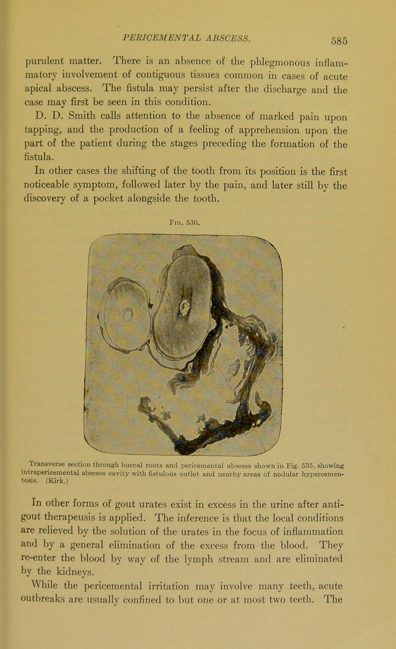 purulent matter. There is an absence of the phlegmonous inflam- matory involvement of contiguous tissues common in cases of acute apical abscess. The fistula may persist after the discharge and the case may first be seen in this condition. D. D. Smith calls attention to the absence of marked pain upon tapping, and the production of a feeling of apprehension upon the part of the patient during the stages preceding the formation of the fistula. In other cases the shifting of the tooth from its position is the first noticeable symptom, followed later by the pain, and later still by the discovery of a pocket alongside the tooth. Fig. 536. Transverse section through buccal roots and pericemental abscess shown in Fig. 535, showing intrapericemental abscess cavity with fistulous outlet and nearby areas of nodular hyperoemen- tosis. (Kirk.) In other forms of gout urates exist in excess in the urine after anti- gout therapeusis is applied. The inference is that the local conditions are relieved by the solution of the urates in the focus of inflammation and by a general elimination of the excess from the blood. They re-enter the blood by way of the lymph stream and are eliminated by the kidneys. While the pericemental irritation may involve many teeth, acute outbreaks are usually confined to but one or at most two teeth. The