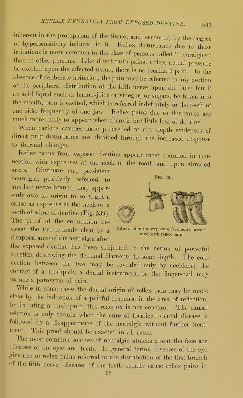 inherent in the protoplasm of the tissue; and, secondly, by the degree of hypersensitivity induced in it. Reflex disturbance due to these irritations is more common in the class of persons called  neurali^ics than in other persons. Like direct pulp pains, unless actual pressure be exerted upon the affected tissue, there is no localized pain. In the absence of deliberate irritation, the pain may be referred to any portion of the peripheral distribution of the fifth nerve upon the face; but if an acid liquid such as lemon-juice or vinegar, or sugars, be taken into the mouth, pain is excited, which is referred indefinitely to the teeth of one side, frequently of one jaw. Reflex pains due to this cause are much more likely to appear when there is but little loss of dentine. When carious cavities have proceeded to any depth evidences of direct pulp disturbance are obtained through the increased response to thermal changes. Reflex pains from exposed dentine appear most common in con- nection with exposures at the neck of the tooth and upon abraded areas. Obstinate and persistent neuralgia, positively referred to Fig. 539. another nerve branch, may appar- ently owe its origin to so slight a cause as exposure at the neck of a tooth of a line of dentine (Fig. 539). The proof of the connection be- tween the two is made clear by a ^^'^'^ °^ dentine exposure frequently associ- j ■ „ , ^ ated with reflex pains. disappearance of the neuralgia after the exposed dentine has been subjected to the action of powerful caustics, destroying the dentinal filaments to some depth. The con- nection betM^een the two may be revealed only by accident; the contact of a toothpick, a dental instrument, or the finger-nail may induce a paroxysm of pain. While in some cases the dental origin of reflex pain may be made clear by the induction of a painful response in the area of reflection, by irritating a tooth pulp, this reaction is not constant. The causal relation is only certain when the cure of localized dental disease is followed by a disappearance of the neuralgia without further treat- ment. This proof should be exacted in all cases. The most common sources of neuralgic attacks about the face are diseases of the eyes and teeth. In general terms, diseases of the eye give rise to reflex pains referred to the distribution of the first branch of the fifth nerve; diseases of the teeth usually cause reflex pains in 38