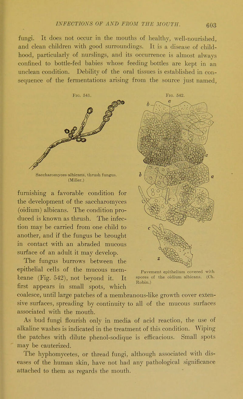 fungi. It does not occur in the mouths of healthy, well-nourished, and clean children with good surroundings. It is a disease of child- hood, particularly of nurslings, and its occurrence is almost always confined to bottle-fed babies whose feeding bottles are kept in an unclean condition. Debility of the oral tissues is established in con- sequence of the fermentations arising from the source just named. Fig. 541. Saccharomyces albicans, thrush fungus. (Miller.) furnishing a favorable condition for the development of the saccharomyces (oidium) albicans. The condition pro- duced is known as thrush. The infec- tion may be carried from one child to another, and if the fungus be brought in contact with an abraded mucous surface of an adult it may develop. The fungus burrows between the epithelial cells of the mucous mem- brane (Fig. 542), not beyond it. It first appears in small spots, which coalesce, until large patches of a membranous-like growth cover exten- sive surfaces, spreading by continuity to all of the mucous surfaces associated with the mouth. As bud fungi flourish only in media of acid reaction, the use of alkaline washes is indicated in the treatment of this condition. Wiping the patches with dilute phenol-sodique is efficacious. Small spots may be cauterized. The hyphomycetes, or thread fungi, although associated with dis- eases of the human skin, have not had any pathological significance attached to them as regards the mouth. Pavement epithelium covered with spores of the oidium albicans. (Ch. Robin.)