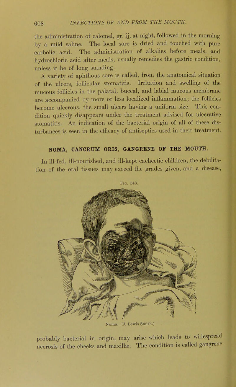 the administration of calomel, gr. ij, at night, followed in the morning by a mild saline. The local sore is dried and touched with pure carbolic acid. The administration of alkahes before meals, and hydrochloric acid after meals, usually remedies the gastric condition, unless it be of long standing. A variety of aphthous sore is called, from the anatomical situation of the ulcers, follicular stomatitis. Irritation and swelling of the mucous follicles in the palatal, buccal, and labial mucous membrane are accompanied by more or less localized inflammation; the follicles become ulcerous, the small ulcers having a uniform size. This con- dition quickly disappears under the treatment advised for ulcerative stomatitis. An indication of the bacterial origin of all of these dis- turbances is seen in the efficacy of antiseptics used in their treatment. NOMA, CANCRUM ORIS, GANGRENE OF THE MOUTH. In ill-fed, ill-nourished, and ill-kept cachectic children, the debilita- tion of the oral tissues may exceed the grades given, and a disease. Fig. 543. Noma. (J. Lewis Smith.) probably bacterial in origin, may arise which leads to widespread necrosis of the cheeks and maxillee. The condition is called gangrene