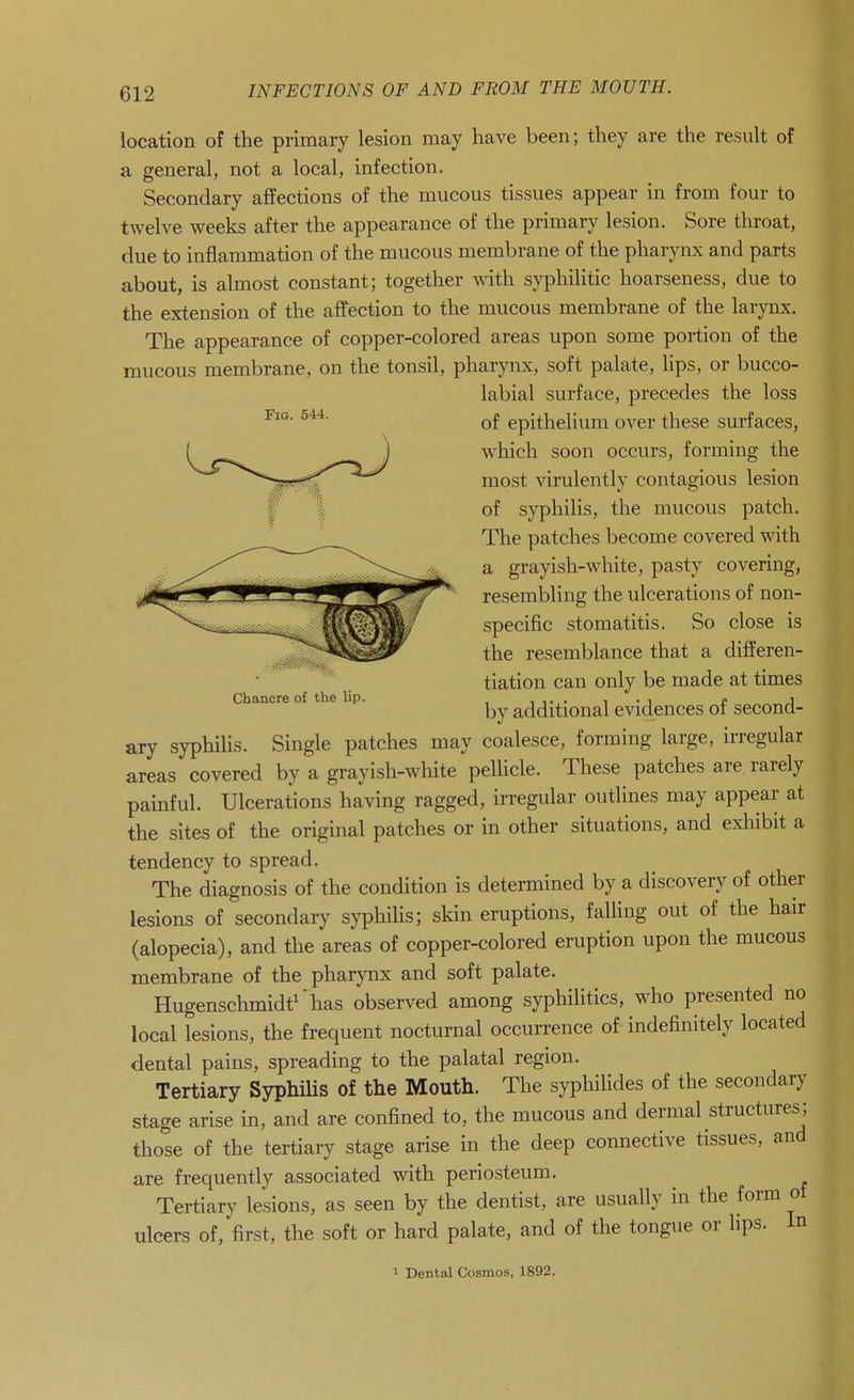 Fig. 544. location of the primary lesion may have been; they are the result of a general, not a local, infection. Secondary affections of the mucous tissues appear in from four to twelve weeks after the appearance of the primary lesion. Sore throat, due to inflammation of the mucous membrane of the pharynx and parts about, is almost constant; together with syphilitic hoarseness, due to the extension of the affection to the mucous membrane of the larynx. The appearance of copper-colored areas upon some portion of the mucous membrane, on the tonsil, pharynx, soft palate, lips, or bucco- labial surface, precedes the loss of epithelium over these surfaces, which soon occurs, forming the most virulently contagious lesion of syphilis, the mucous patch. The patches become covered with a grayish-white, pasty covering, resembling the ulcerations of non- specific stomatitis. So close is the resemblance that a differen- tiation can only be made at times by additional evidences of second- ary syphilis. Single patches may coalesce, forming large, irregular areas covered by a grayish-white pellicle. These patches are rarely painful. Ulcerations having ragged, irregular outlines may appear at the sites of the original patches or in other situations, and exliibit a tendency to spread. The diagnosis of the condition is determined by a discovery of other lesions of secondary syphilis; skin eruptions, falUng out of the hair (alopecia), and the areas of copper-colored eruption upon the mucous membrane of the pharynx and soft palate. Hugensclimidt^'has observed among syphilitics, who presented no local lesions, the frequent nocturnal occurrence of indefinitely located dental pains, spreading to the palatal region. Tertiary Syphilis of the Mouth. The syphilides of the secondary stage arise in, and are confined to, the mucous and dermal structures; those of the tertiary stage arise in the deep connective tissues, and are frequently associated with periosteum. Tertiary lesions, as seen by the dentist, are usually in the form ot ulcers of, first, the soft or hard palate, and of the tongue or lips. In Chancre of the lip.