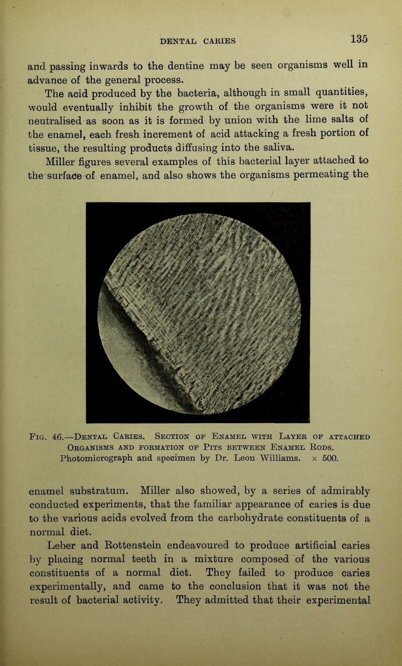 and passing inwards to the dentine may be seen organisms well in advance of the general process. The acid produced by the bacteria, although in small quantities, would eventually inhibit the growth of the organisms were it not neutralised as soon as it is formed by union with the lime salts of the enamel, each fresh increment of acid attacking a fresh portion of tissue, the resulting products diffusing into the saliva. Miller figures several examples of this bacterial layer attached to the surface of enamel, and also shows the organisms permeating the Fig. 46.—Dental Caries. Section of Enamel with Layer of attached Organisms and formation of Pits between Enamel Rods. Photomicrograph and specimen by Dr. Leon Williams, x 600. enamel substratum. Miller also showed, by a series of admirably conducted experiments, that the familiar appearance of caries is due to the various acids evolved from the carbohydrate constituents of a normal diet. Leber and Eottenstein endeavoured to produce artificial caries by placing normal teeth in a mixture composed of the various constituents of a normal diet. They failed to produce caries experimentally, and came to the conclusion that it was not the result of bacterial activity. They admitted that their experimental