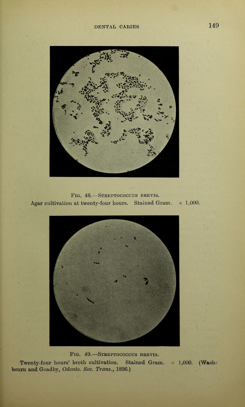 Fig. 49.—Streptococcus beevis. Twenty-four hours' broth cultivation. Stained Gram, x 1,000. (Wash- bourn and Goadby, Odonto. Soc. Trans., 1896.)