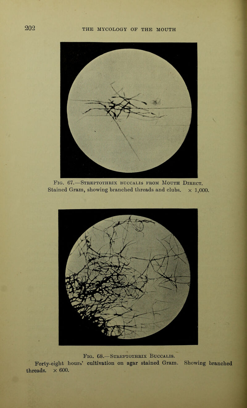 Fig. 68.—SxiiEPTOTHKix Buccalis. Forty-eight hourb' cultivation on agar stained Gram. Showing branched threads, x 600.