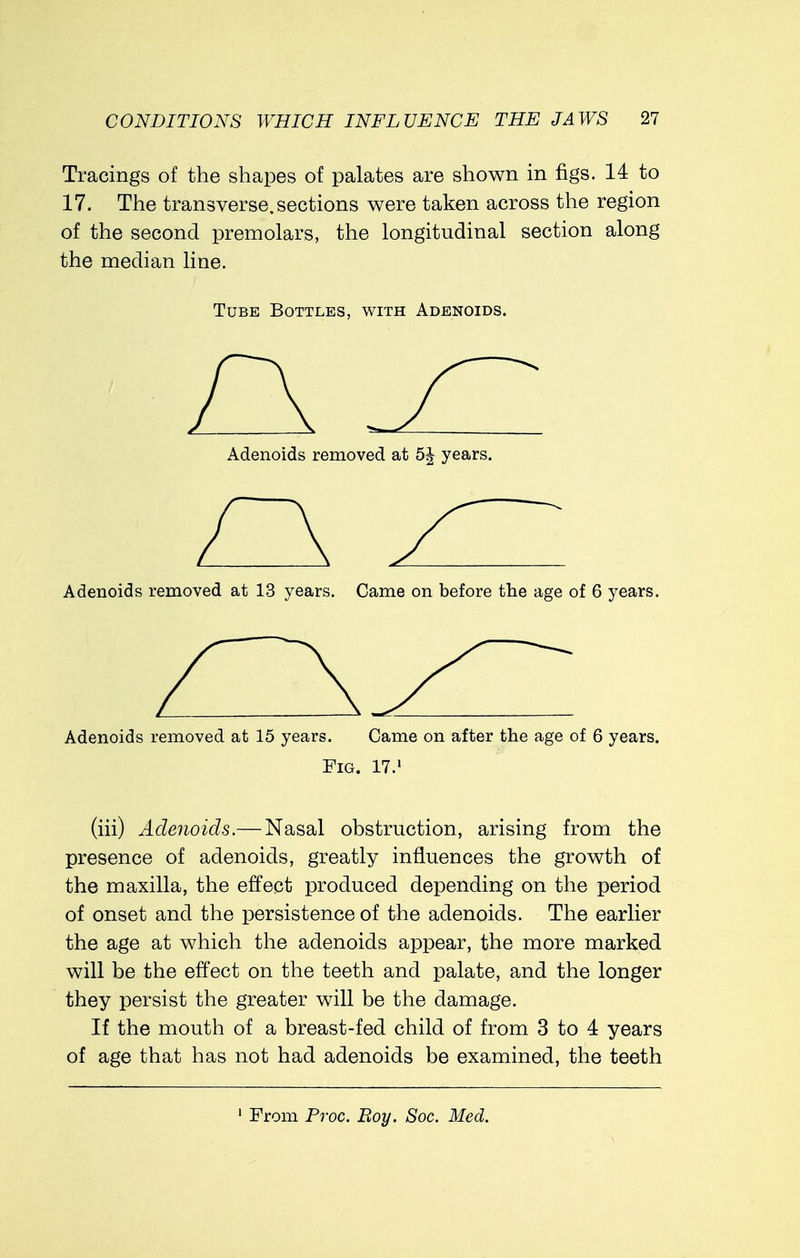 Tracings of the shapes of palates are shown in figs. 14 to 17. The transverse.sections were taken across the region of the second premolars, the longitudinal section along the median line. Tube Bottles, with Adenoids. Adenoids removed at years. Adenoids removed at 13 years. Came on before the age of 6 years. Adenoids removed at 15 years. Came on after the age of 6 years. Fig. 17.1 (hi) Adenoids.— Nasal obstruction, arising from the presence of adenoids, greatly influences the growth of the maxilla, the effect produced depending on the period of onset and the persistence of the adenoids. The earlier the age at which the adenoids appear, the more marked will be the effect on the teeth and palate, and the longer they persist the greater will be the damage. If the mouth of a breast-fed child of from 3 to 4 years of age that has not had adenoids be examined, the teeth
