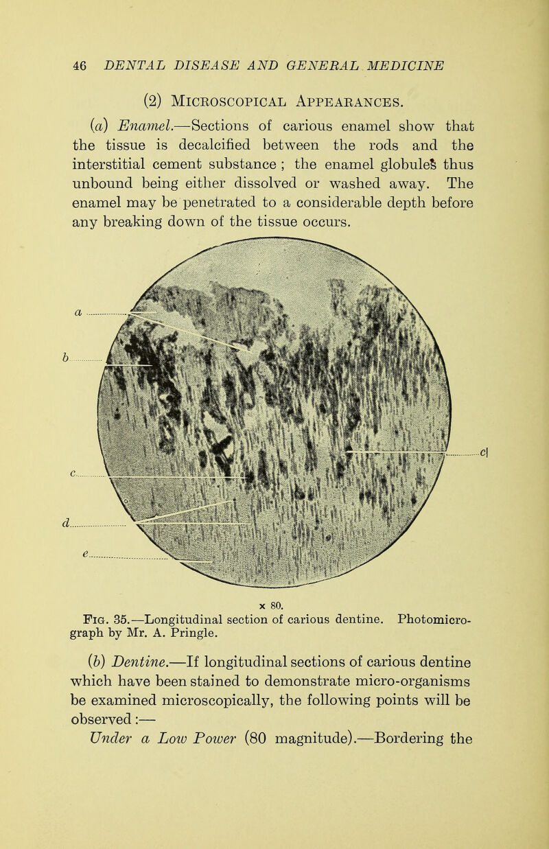 (2) Microscopical Appearances. (a) Enamel.—Sections of carious enamel show that the tissue is decalcified between the rods and the interstitial cement substance ; the enamel globule^ thus unbound being either dissolved or washed away. The enamel may be penetrated to a considerable depth before any breaking down of the tissue occurs. c\ x 80. Fig. 35.—Longitudinal section of carious dentine. Photomicro- graph by Mr. A. Pringle. (b) Dentine.—If longitudinal sections of carious dentine which have been stained to demonstrate micro-organisms be examined microscopically, the following points will be observed:— Under a Loto Power (80 magnitude).—Bordering the