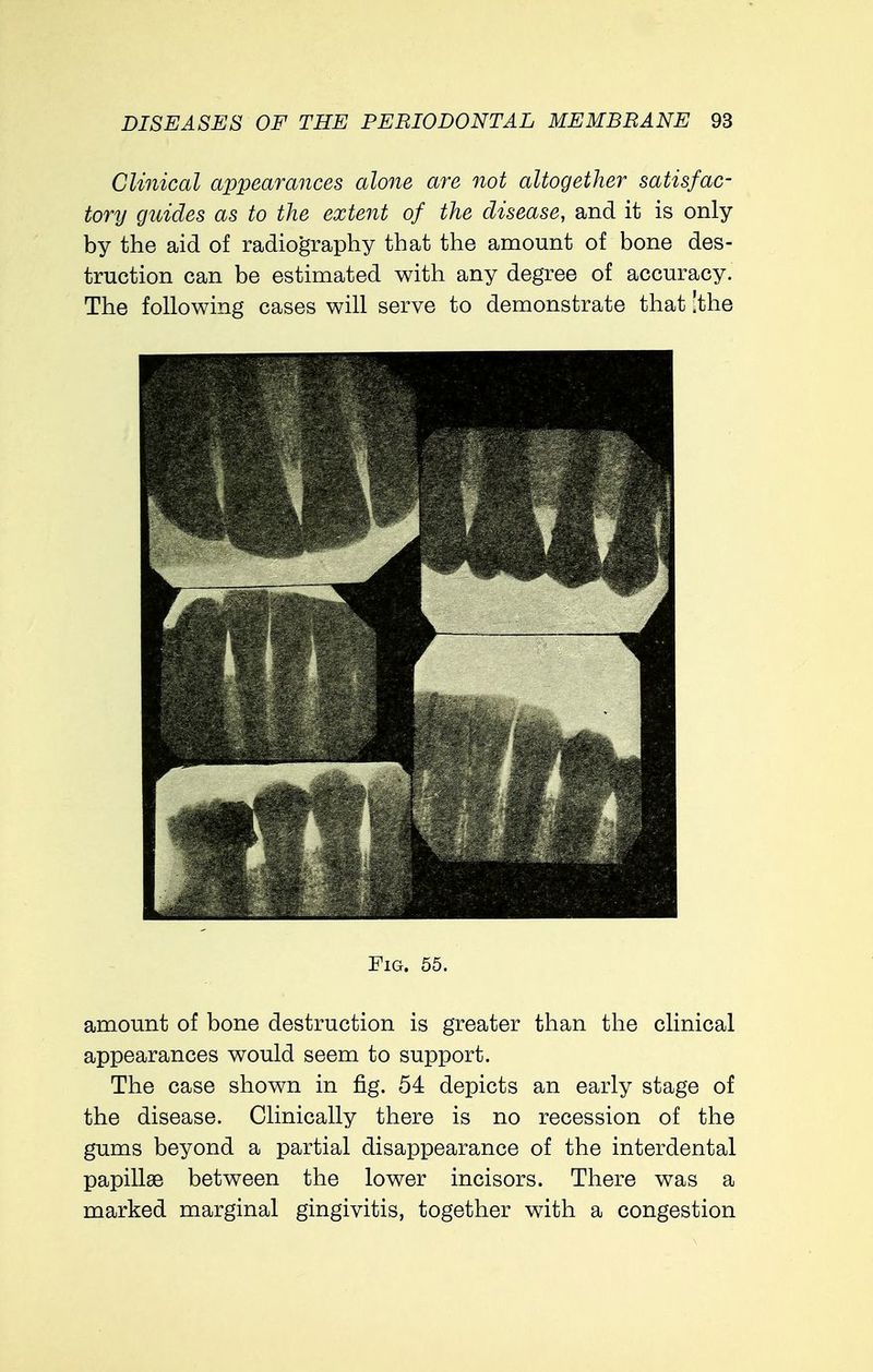 Clinical appearances alone are not altogether satisfac- tory guides as to the extent of the disease, and it is only by the aid of radiography that the amount of bone des- truction can be estimated with any degree of accuracy. The following cases will serve to demonstrate that [the J Fig. 55. amount of bone destruction is greater than the clinical appearances would seem to support. The case shown in fig. 54 depicts an early stage of the disease. Clinically there is no recession of the gums beyond a partial disappearance of the interdental papillae between the lower incisors. There was a marked marginal gingivitis, together with a congestion