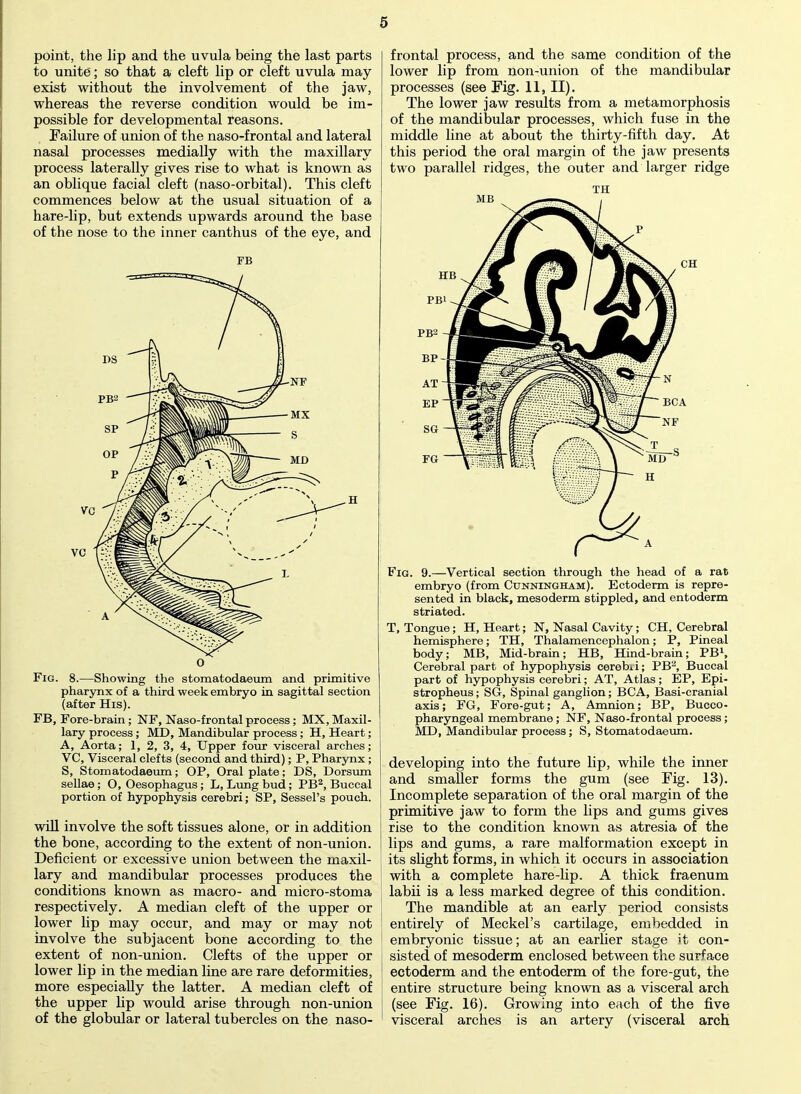 point, the lip and the uvula being the last parts to unite; so that a cleft lip or cleft uvula may exist without the involvement of the jaw, whereas the reverse condition would be im- possible for developmental reasons. Failure of union of the naso-frontal and lateral nasal processes medially with the maxillary process laterally gives rise to what is known as an oblique facial cleft (naso-orbital). This cleft commences below at the usual situation of a hare-lip, but extends upwards around the base of the nose to the inner canthus of the eye, and F15 H o Fig. 8.—Showing the stomatodaeum and primitive pharynx of a third week embryo in sagittal section (after His). FB, Fore-brain ; NF, Naso-frontal process; MX, Maxil- lary process ; MD, Mandibular process ; H, Heart; A, Aorta; 1, 2, 3, 4, Upper four visceral arches; VC, Visceral clefts (second and third); P, Pharynx ; S, Stomatodaeum; OP, Oral plate; DS, Dorsum sellae ; O, Oesophagus ; L, Lung bud; PB2, Buccal portion of hypophysis cerebri; SP, Sessel's pouch. will involve the soft tissues alone, or in addition the bone, according to the extent of non-union. Deficient or excessive union between the maxil- lary and mandibular processes produces the conditions known as macro- and micro-stoma respectively. A median cleft of the upper or lower lip may occur, and may or may not involve the subjacent bone according to the extent of non-union. Clefts of the upper or lower hp in the median line are rare deformities, more especially the latter. A median cleft of the upper lip would arise through non-union of the globular or lateral tubercles on the naso- frontal process, and the same condition of the lower lip from non-union of the mandibular processes (see Fig. 11, II). The lower jaw results from a metamorphosis of the mandibular processes, which fuse in the middle line at about the thirty-fifth day. At this period the oral margin of the jaw presents two parallel ridges, the outer and larger ridge Fig. 9.—Vertical section through the head of a rat embryo (from Cunningham). Ectoderm is repre- sented in black, mesoderm stippled, and entoderm striated. T, Tongue ; H, Heart; N, Nasal Cavity; CH, Cerebral hemisphere; TH, Thalamencephalon; P, Pineal body; MB, Mid-brain; HB, Hind-brain; PB1, Cerebral part of hypophysis cerebri; PBa, Buccal part of hypophysis cerebri; AT, Atlas; EP, Epi- stropheus ; SG, Spinal ganglion; BCA, Basi-cranial axis; FG, Fore-gut; A, Amnion; BP, Bucco- pharyngeal membrane; NF, Naso-frontal process; MD, Mandibular process; S, Stomatodaeum. developing into the future lip, while the inner and smaller forms the gum (see Fig. 13). Incomplete separation of the oral margin of the primitive jaw to form the lips and gums gives rise to the condition known as atresia of the lips and gums, a rare malformation except in its slight forms, in which it occurs in association with a complete hare-lip. A thick fraenum labh is a less marked degree of this condition. The mandible at an early period consists entirely of Meckel's cartilage, embedded in embryonic tissue; at an earher stage it con- sisted of mesoderm enclosed between the surface ectoderm and the entoderm of the fore-gut, the entire structure being known as a visceral arch (see Fig. 16). Growing into each of the five visceral arches is an artery (visceral arch