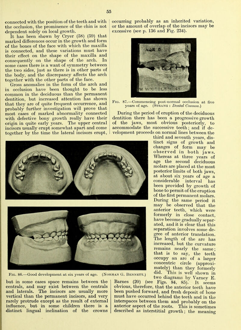 connected with the position of the teeth and with the occlusion, the prominence of the chin is not dependent solely on local growth. It has been shown by Cryer (58) (59) that marked differences occur in the growth and form of the bones of the face with which the maxilla is connected, and these variations must have their effect on the shape of the maxilla and consequently on the shape of the arch. In some cases there is a want of symmetry between the two sides, just as there is in other parts of the body, and the discrepancy affects the arch together with the other parts of the face. Gross anomalies in the form of the arch and occlusion have been thought to be less m common in the deciduous than the permanent dentition, but increased attention has shown that they are of quite frequent occurrence, and probably further investigation will prove that most cases of marked abnormality connected with defective bony growth really have their origin in quite early years. The upper central incisors usually erupt somewhat apart and come together by the time the lateral incisors erupt, occurring probably as an inherited variation, or the amount of overlap of the incisors may be excessive (see p. 136 and Fig. 234). Fig. 86.—Good development at six years of age. but in some cases space remains between the centrals, and may exist between the centrals and laterals. The incisors are usually more vertical than the permanent incisors, and very rarely protrude except as the result of external influence, but in some children there is a distinct lingual inclination of the crowns Fig. 87.—Commencing post-normal occlusion at five years of age. (Strang : Dental Cosmos.) During the period of eruption of the deciduous dentition there has been a progressive growth of the jaws, most obvious posteriorly, to accommodate the successive teeth; and if de- velopment proceeds on normal lines between the third and seventh years, dis- tinct signs of growth and changes of form may be observed in both jaws. Whereas at three years of age the second deciduous molars are placed at the most posterior limits of both jaws, at about six years of age a considerable interval has been provided by growth of bone to permit of the eruption of the first permanent molars. During the same period it may be observed that the anterior teeth, which were formerly in close contact, have become gradually separ- ated, and it is clear that this separation involves some de- gree of anterior translation. The length of the arc has increased, but the curvature remains nearly the same; that is to say, the teeth occupy an arc of a larger concentric circle (approxi- mately) than they formerly did. This is well shown in two diagrams by Varney E. Figs. 84, 85). It seems obvious, therefore, that the anterior teeth have been pushed forward, and fresh deposit of bone must have occurred behind the teeth and in the interspaces between them and probably on the anterior aspect of the roots. This is sometimes described as interstitial growth; the meaning (Norman G. Bennett.) Barnes (20) (see