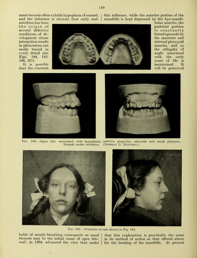 nasal stenosis often exhibit hypoplasia of enamel, and the inference is obvious that early mal- nutrition has been the origin of several defective conditions of de- velopment whose interaction results in phenomena not easily traced in every detail (see Figs. 184, 185, 186, 187). It is possible that the constant this influence, while the anterior portion of the mandible is kept depressed by the hyo-mandi- bular muscles, the posterior portion is constantly forced upwards by the masseter and internal pterygoid muscles, and so the obliquity of angle associated with the early years of life is maintained. It will be perceived Fig. 184.—Open bite associated with hypoplasia, anterior gingivitis, adenoids and small pharynx. Normal molar occlusion. (Norman G. Bennett.) Fig. 185. -Portraits of case shown in Fig. 184. habit of mouth-breathing consequent on nasal I that this explanation is practically the same stenosis may be the initial cause of open bite. I in its method of action as that offered above esaC, in 1894, advanced the view that under | for the bending of the mandible. At present