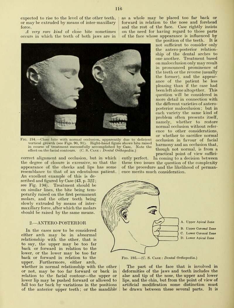 expected to rise to the level of the other teeth, or may be extruded by means of inter-maxillary force. A very rare kind of close bite sometimes occurs in which the teeth of both jaws are in Fig. 194.—-Close bite with normal occlusion, apparently due to deficient vertical growth (see Figs. 90, 91). Right-hand figure shows bite raised in course of treatment successfully accomplished by Case. Note the effect on tho facial contours. (C. S. Case : Dental Orthopedia.) correct alignment and occlusion, but in which the degree of closure is excessive, so that the appearance of the cheeks and lips has some resemblance to that of an edentulous patient. An excellent example of this is de- scribed and figured by Case (43, p. 322; see Fig. 194). Treatment should be on similar lines, the bite being tem- porarily raised on the first permanent molars, and the other teeth being slowly extruded by means of inter- maxillary force, after which the molars should be raised by the same means. 2.—ANTEROPOSTERIOR In the cases now to be considered either arch may be in abnormal relationship with the other, that is to say, the upper may be too far back or forward in relation to the lower, or the lower may be too far back or forward in relation to the upper. Furthermore, either arch, whether in normal relationship with the other or not, may be too far forward or back in relation to the facial contour—the upper or lower lip may be pushed forward or allowed to fall too far back by variations in the positions of the anterior upper teeth ; or the mandible as a whole may be placed too far back or forward in relation to the nose and forehead and the rest of the face. Case rightly insists on the need for having regard to those parts of the face whose appearance is influenced by the position of the teeth. It is not sufficient to consider only the antero-posterior relation- ship of the dental arches to one another. Treatment based on malocclusion only may result in pronounced prominence of the teeth or the reverse (usually the former), and the appear- ance of the patient be less pleasing than if the case had been left alone altogether. This question will be considered in more detail in connection with the different varieties of antero- posterior malocclusion; but in each variety the same kind of problem often presents itself, namely, whether to restore normal occlusion without refer- ence to other considerations, or whether to sacrifice normal occlusion in favour of facial harmony and an occlusion that, though not normal, is from a practical point of view suffici- ently perfect. In coming to a decision between these two issues the question of the complexity of the procedure and the likelihood of perman- ence merits much consideration. A. Upper Apical Zone B. Upper Coronal Zone C. Lower Coronal Zone D. Lower Apical Zone Fig. 195.—(C. S. Case : Dental Orthopedia.) The part of the face that is involved in deformities of the jaws and teeth includes the alae and tip of the nose, the upper and lower lips, and the chin, but from the point of view of artificial modification some distinction must be drawn between these several parts. It is