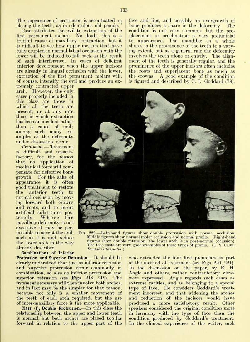 The appearance of protrusion is accentuated on closing the teeth, as in edentulous old people. Case attributes the evil to extraction of the first permanent molars. No doubt this is a fruitful cause of maxillary contraction, but it is difficult to see how upper incisors that have fully erupted in normal labial occlusion with the lower will be induced to fall back as the result of such interference. In cases of deficient anterior development when the upper incisors are already in lingual occlusion with the lower, extraction of the first permanent molars will, of course, intensify the evil and produce an ex- tremely contracted upper arch. However, the only cases properly included in this class are those in which all the teeth are present, or at any rate those in which extraction has been an incident rather than a cause of evil; among such many ex- amples of the deformity under discussion occur. Treatment.— Treatment is difficult and unsatis- factory, for the reason that no application of mechanical force will com- pensate for defective bony growth. For the sake of appearance it is often good treatment to restore the anterior teeth to normal occlusion by mov- ing forward both crowns and roots, and to insert artificial substitutes pos- teriorly. Where the maxillary deformity is not excessive it may be per- missible to accept the evil, such as it is and reduce the lower arch in the way already described. Combinations of Inferior Protrusion and Superior Retrusion.—It should be clearly understood that just as inferior retrusion and superior protrusion occur commonly in combination, so also do inferior protrusion and superior retrusion (see Figs. 218, 219). The treatment necessary will then involve both arches, and in fact may be the simpler for that reason, because not only is a smaller movement of the teeth of each arch required, but the use of inter-maxillary force is the more applicable. Class (f), Double Protrusion.—In this class the relationship between the upper and lower teeth is normal, but both arches are placed too far forward in relation to the upper part of the face and lips, and possibly an overgrowth of bone produces a share in the deformity. The condition is not very common, but the pre- placement or proclination is very prejudicial to appearance. The mandible as a whole shares in the prominence of the teeth to a vary- ing extent, but as a general rule the deformity involves the teeth alone or chiefly. The align- ment of the teeth is generally regular, and the prominence of the upper incisors often includes the roots and superjacent bone as much as the crowns. A good example of the condition is figured and described by C. L. Goddard (78), Fig. 222.—Left-hand figures show double protrusion with normal occlusion. Middle figures show normal molar occlusion and normal profile. Right-hand figures show double retrusion (the lower arch is in post-normal occlusion). The face casts are very good examples of these types of profile. (C. S. Case : Dental Orthopedia ) who extracted the four first premolars as part of the method of treatment (see Figs. 220, 221). In the discussion on the paper, by E. H. Angle and others, rather contradictory views were expressed. Angle regards such cases as extreme rarities, and as belonging to a special type of face. He considers Goddard's treat- ment incorrect, and that widening the arches and reduction of the incisors would have produced a more satisfactory result. Other speakers considered the original condition more in harmony with the type of face than the condition produced by Goddard's treatment. In the clinical experience of the writer, such