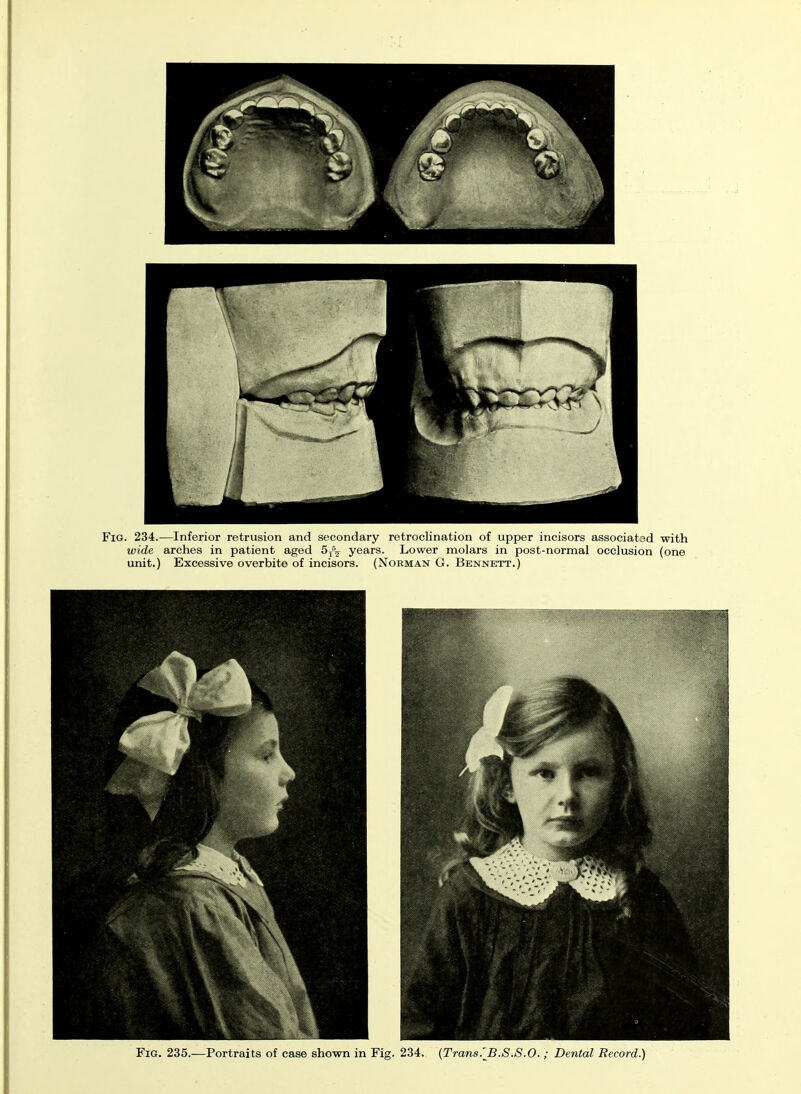 Fig. 234.—Inferior retrusion and secondary retroclination of upper incisors associatad with wide arches in patient aged years. Lower molars in post-normal occlusion (one unit.) Excessive overbite of incisors. (Norman G. Bennett.) Fig. 235.—Portraits of case shown in Fig. 234. (Trans.'B.S.S.O. ; Dental Record.)